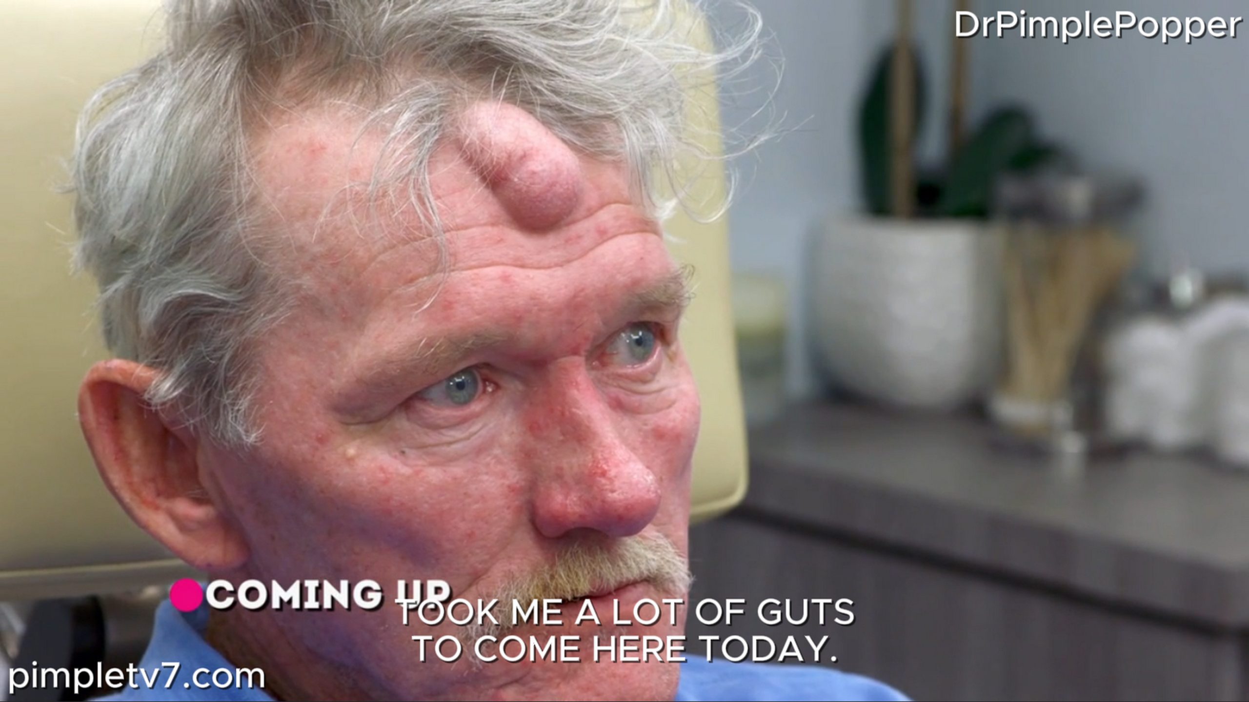 A man covers his big head growth with hats. Dr. Pimple Popper 300626