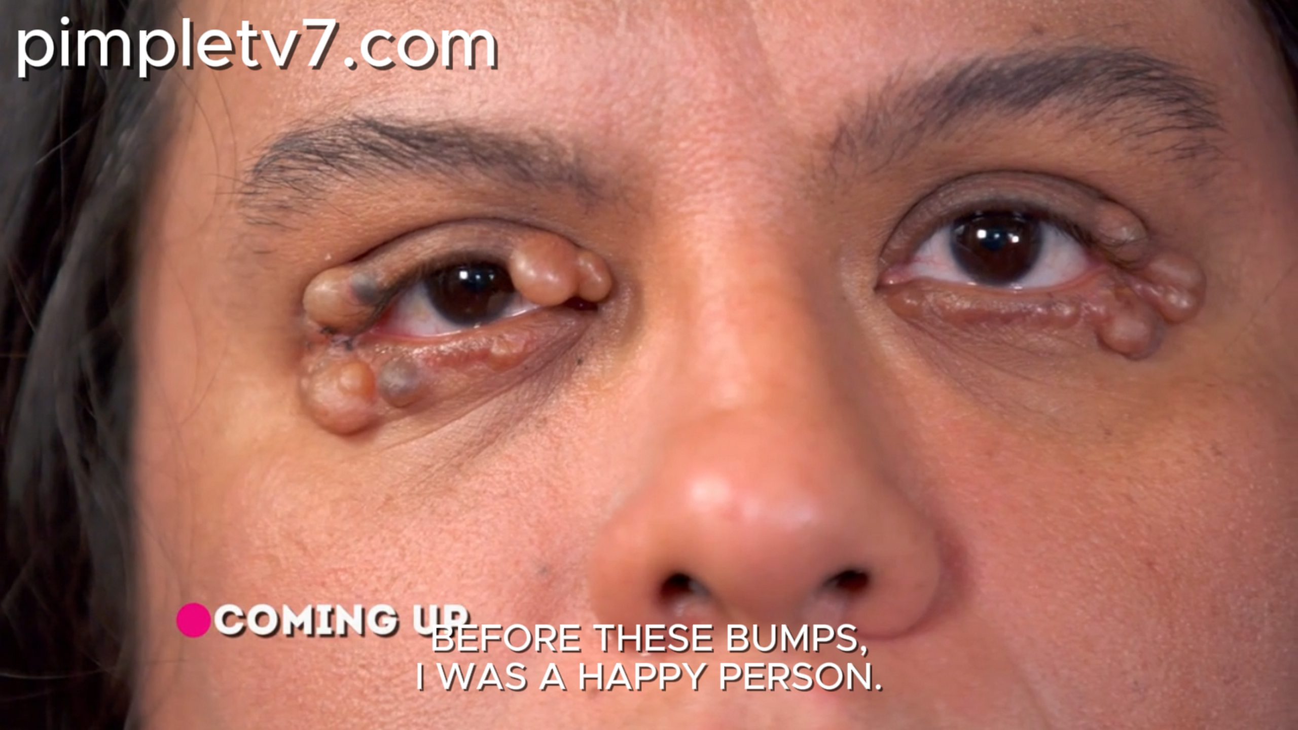 A woman faces depression due to her eyelid bumps. Dr. Pimple Popper 290626