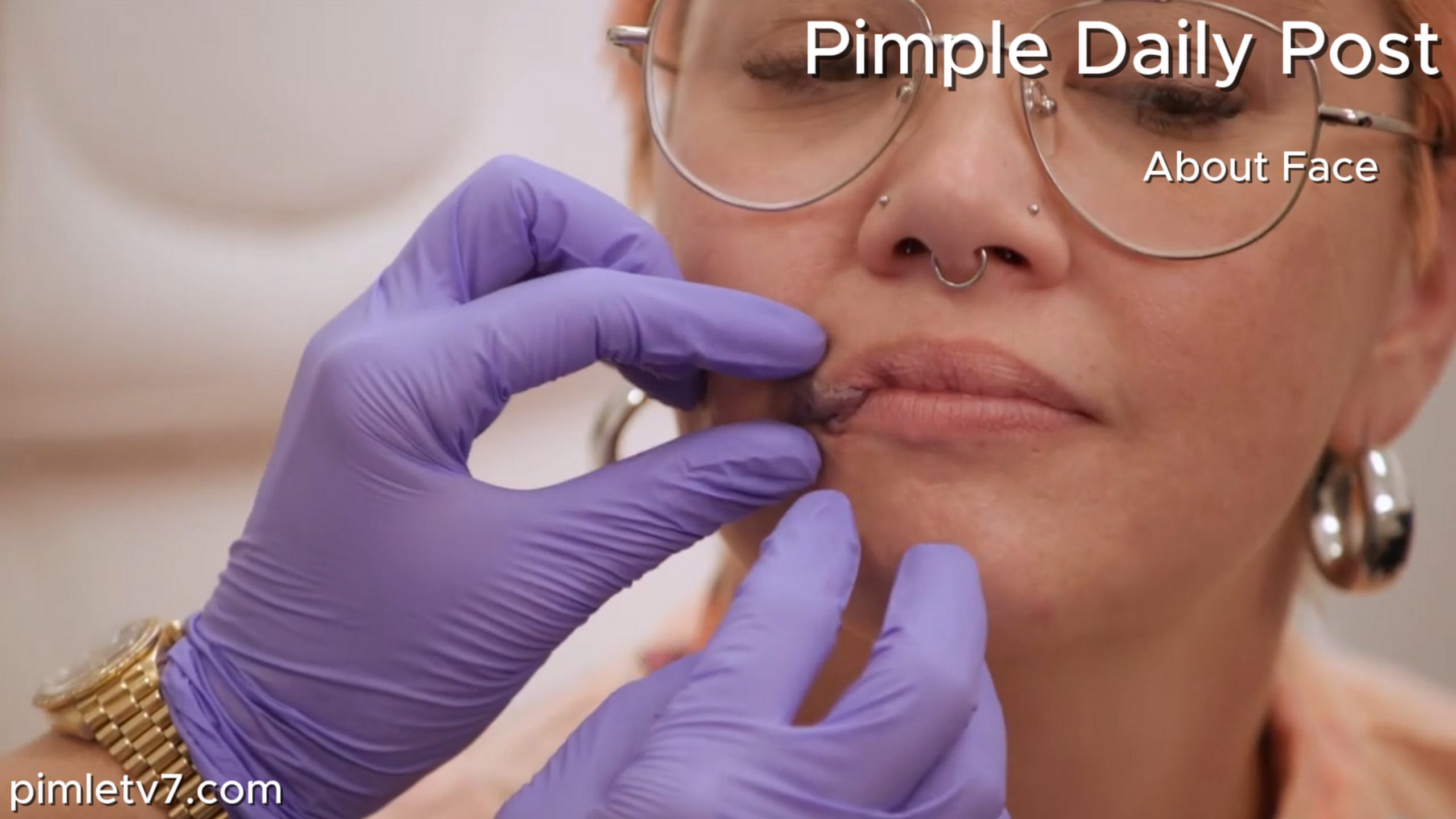 A woman hopes Dr. Rovelo can remove her mouthy birthmark. About Face 160626