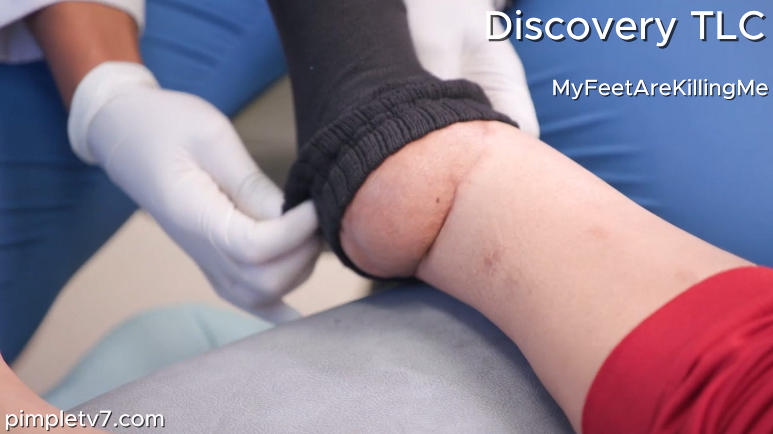 A woman who walked on a broken leg for 10 years is Dr. Ebonie’s most difficult surgery yet. MyFeetAreKillingMe 230626