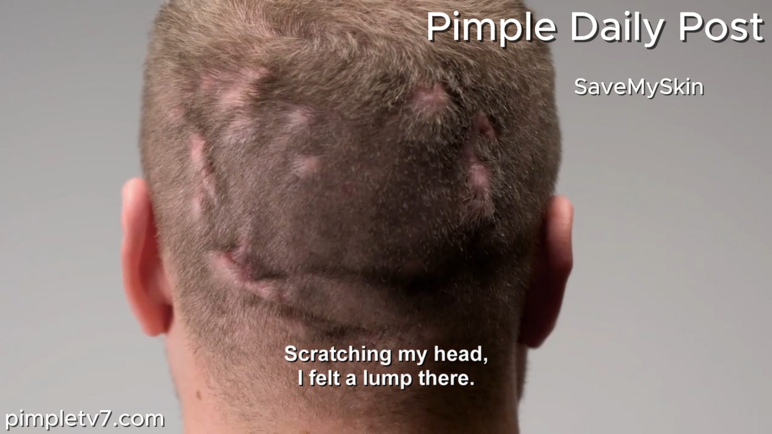 Alex wants the lumps on the back of his head removed. SaveMySkin 200626