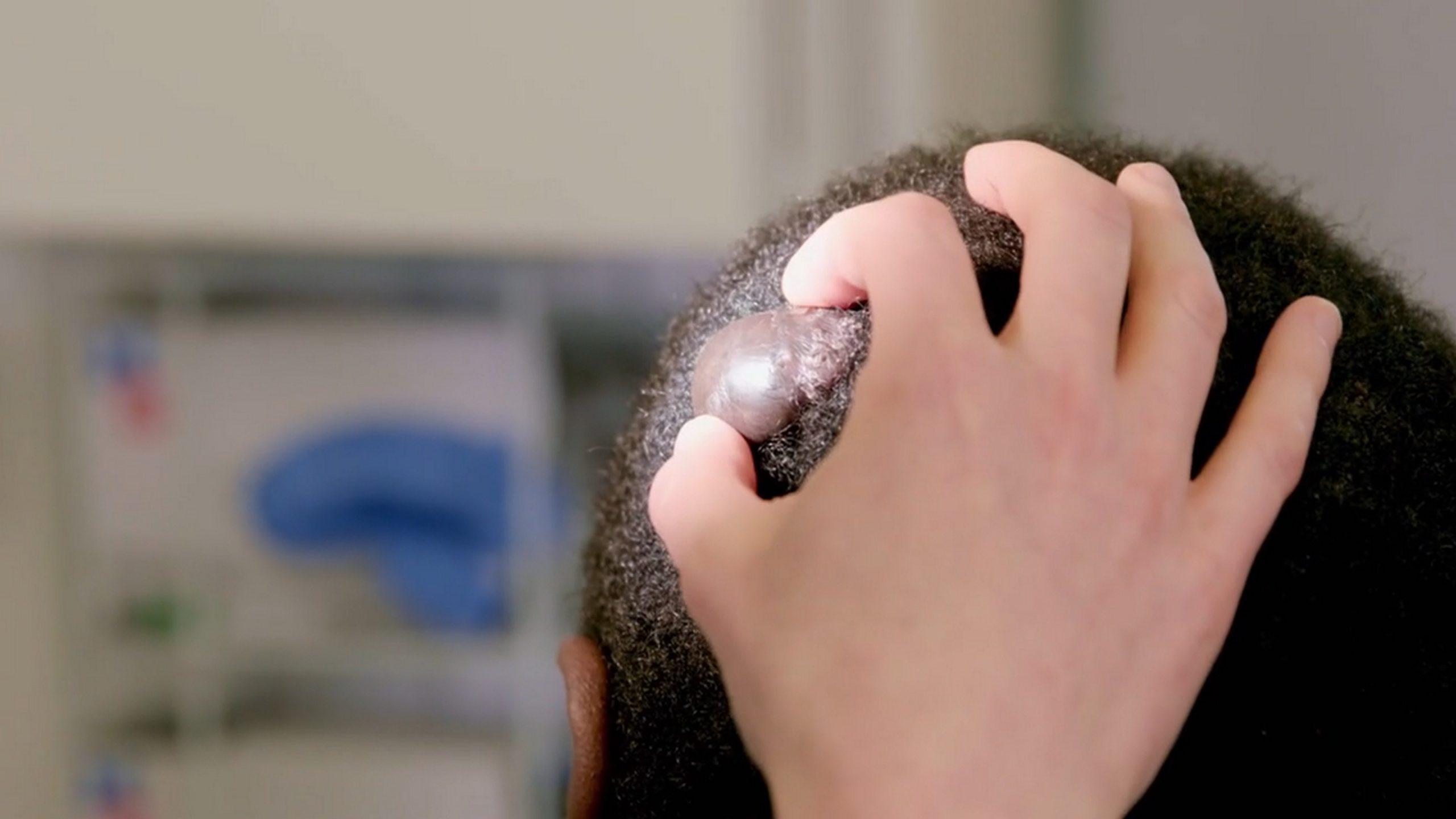Andrew dreams of finding love, but the bumps on his scalp are turning off the ladies. SaveMySkin 210626