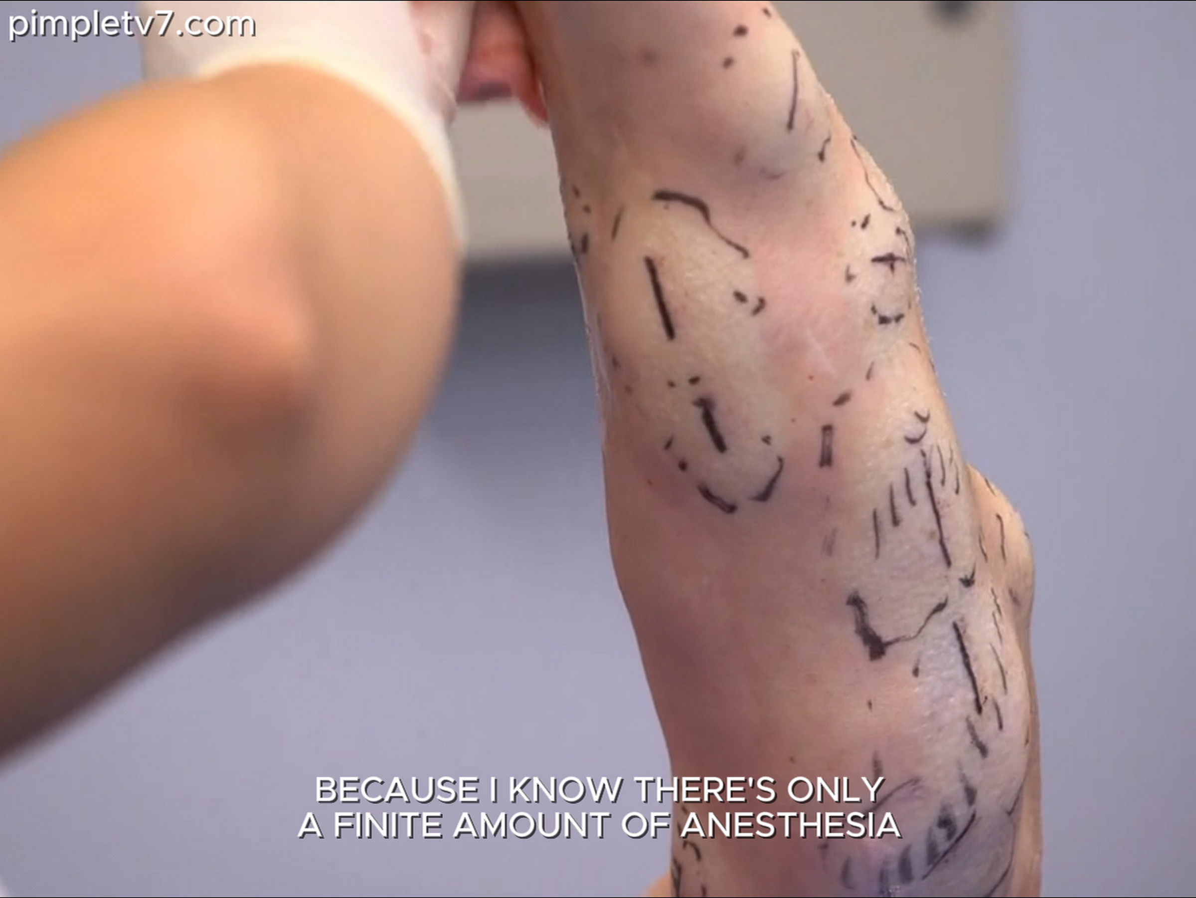 April is covered in bumps that have disfigured her arms. Dr. Pimple Popper 220626