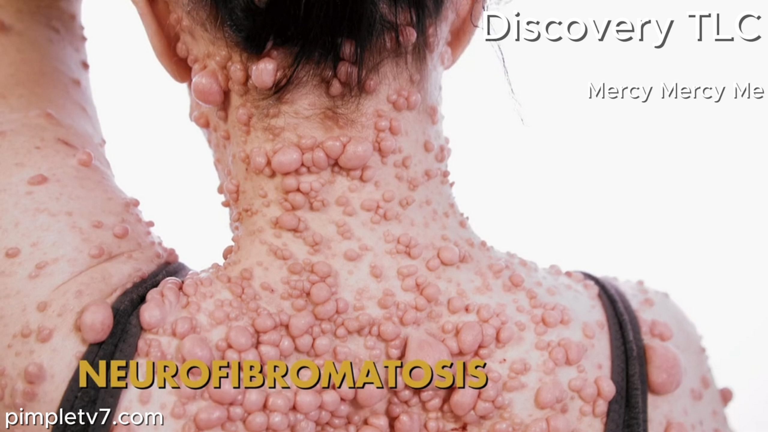 Ashley’s case of neurofibromatosis is one of the worst in the country. Mercy Mercy Me 160626
