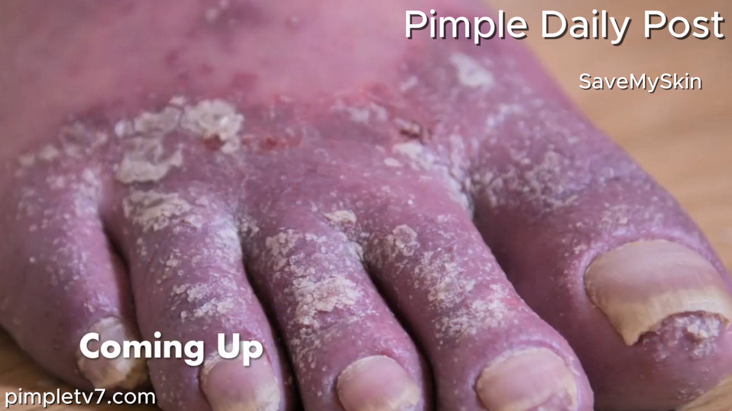 Chris’ psoriasis puts a strain on his marriage. SaveMySkin 160626