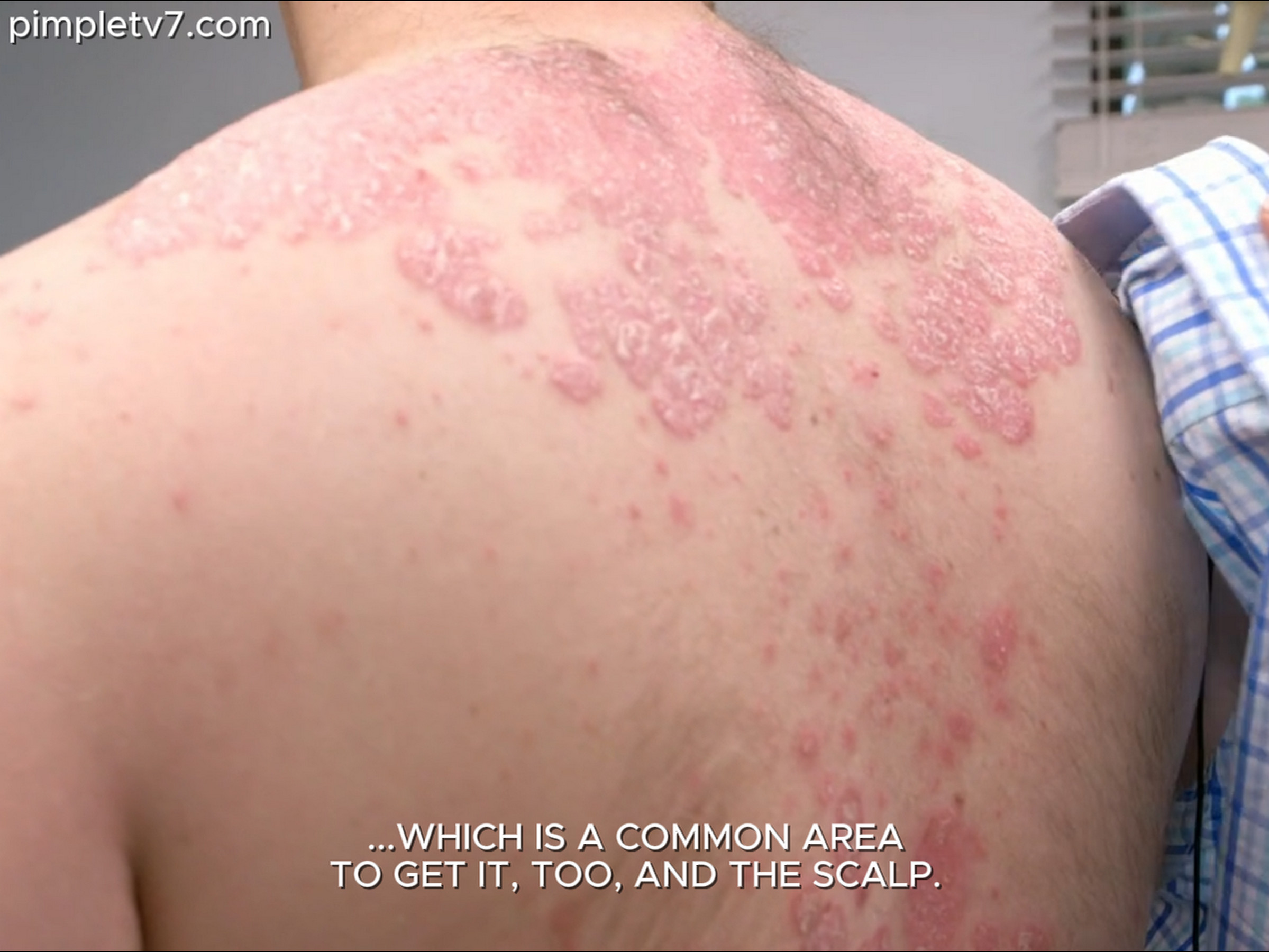 Chris suffers from psoriasis that nearly covers his body and a bump on his head. Dr. Pimple Popper 230626