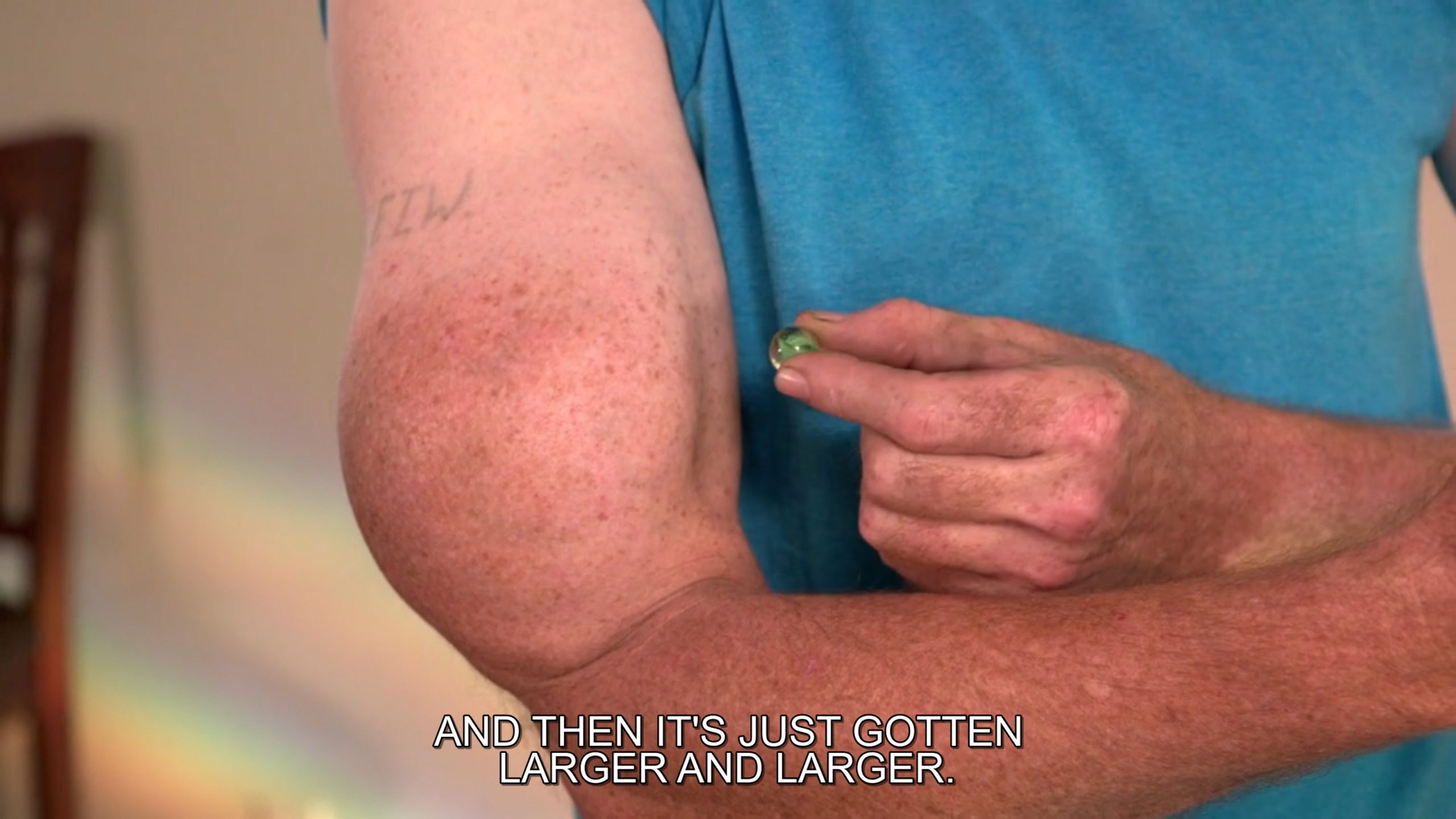 Chuck has a bump on his arm, and his teenage brothers have matching lumps. Dr. Pimple Popper 240626