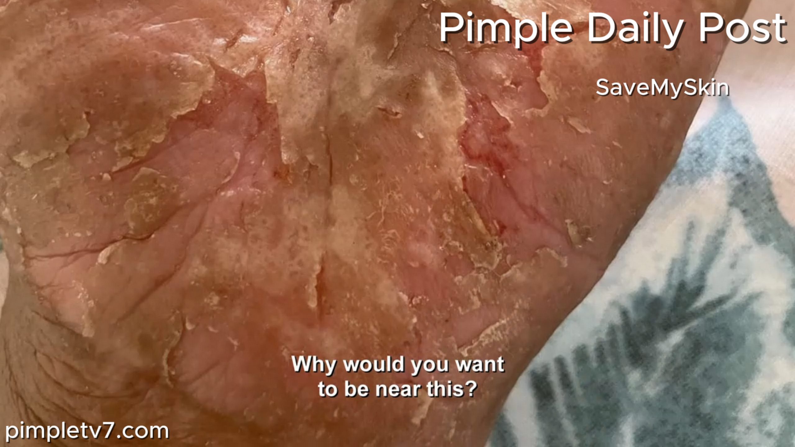 Cianca’s smoking causes severe dermatitis. SaveMySkin 150626