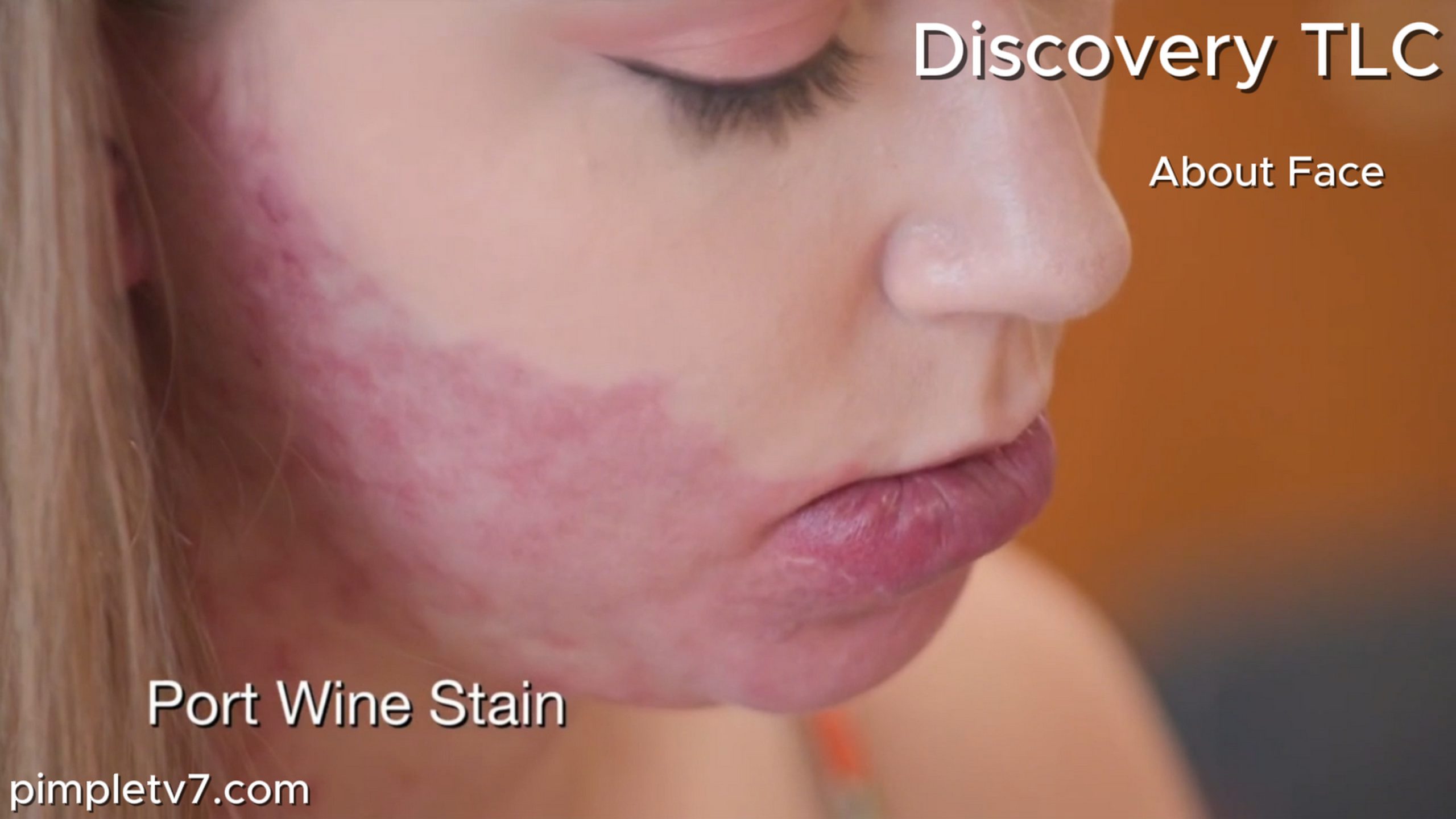 Danielle Capelli, a woman whose lower lip won’t stop growing, turns to Dr. Rovelo for help. About Face 150626