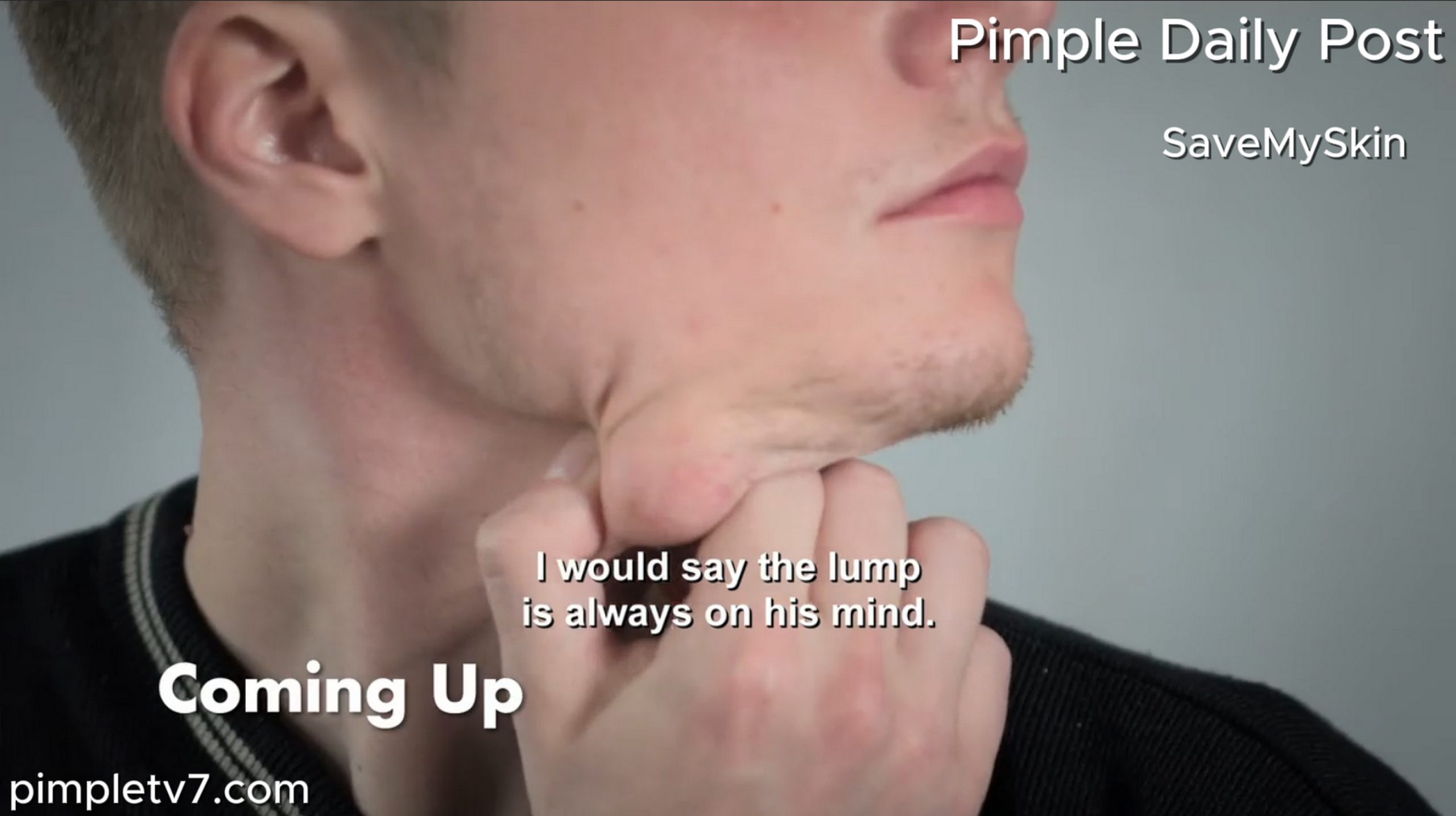 Dillon doesn’t want to go to college with a lump under his chin. SaveMySkin 140626