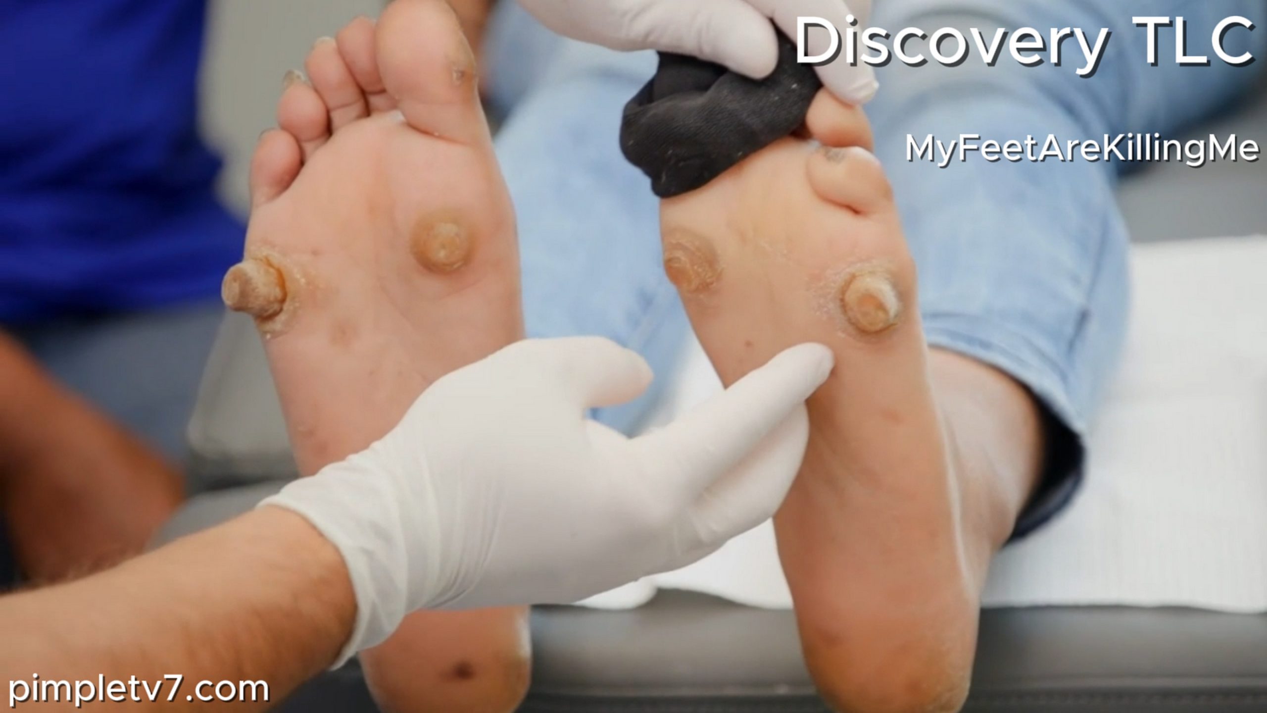 Dr. Brad removes growths like horns coming out of a woman’s feet. MyFeetAreKillingMe 260626