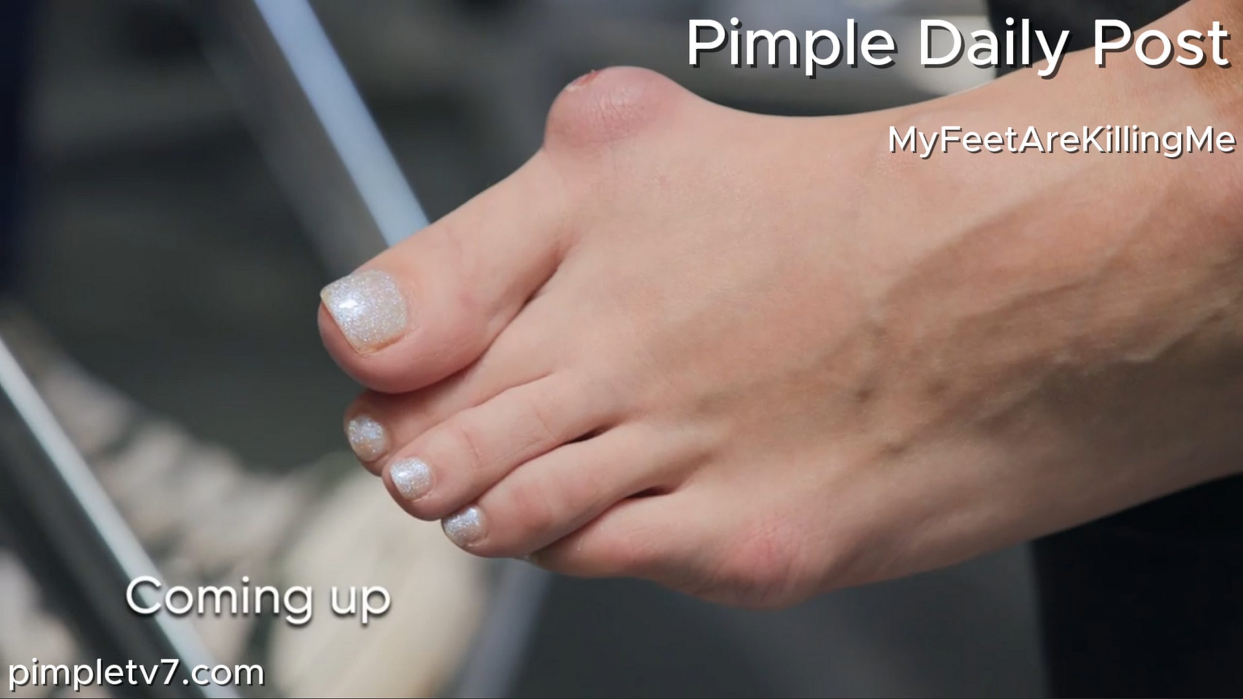 Dr. Ebonie faces a bunion that looks like something from a horror movie. MyFeetAreKillingMe 180626