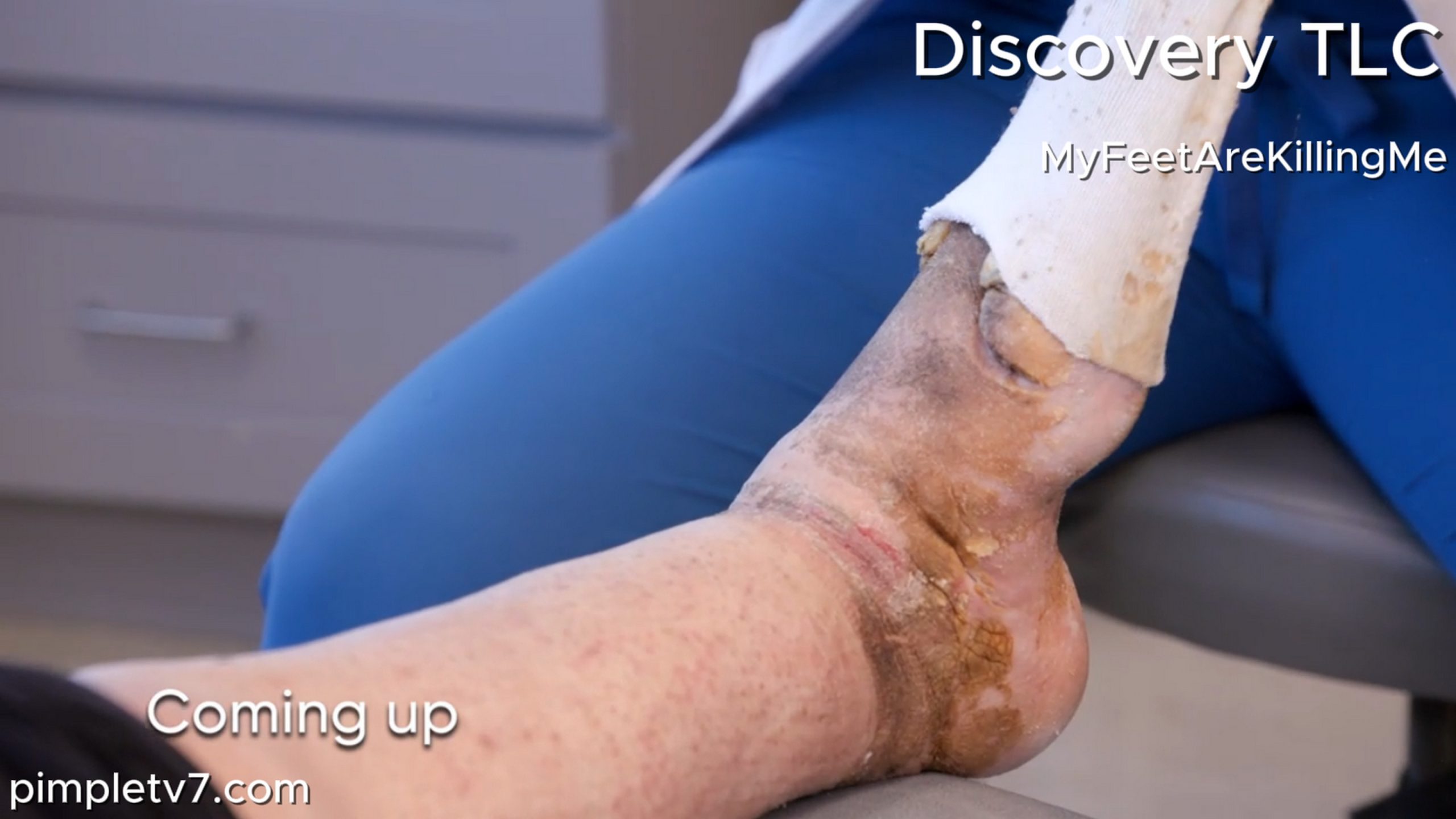 Dr. Ebonie helps a woman who hasn’t seen her foot in almost two years—it’s anyone’s guess what is underneath the surgical boot! MyFeetAreKillingMe 260626