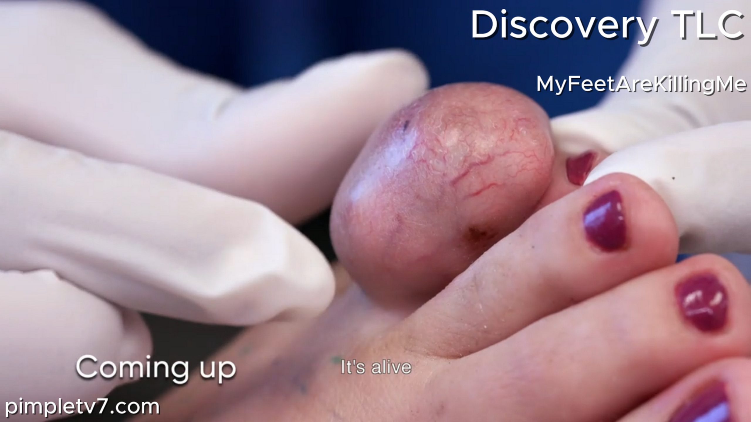 Dr. Ebonie removes an alien brain growing out of a cancer-survivor’s toe. MyFeetAreKillingMe 280626
