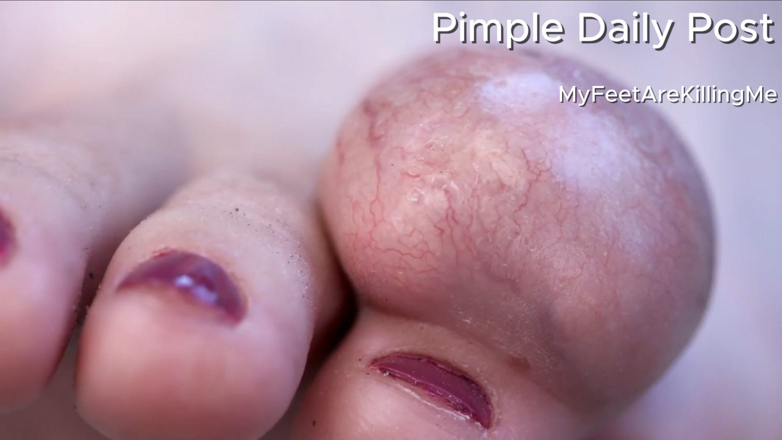 Dr. Ebonie removes an “alien brain” growing out of a cancer-survivor’s toe. MyFeetAreKillingMe 140626