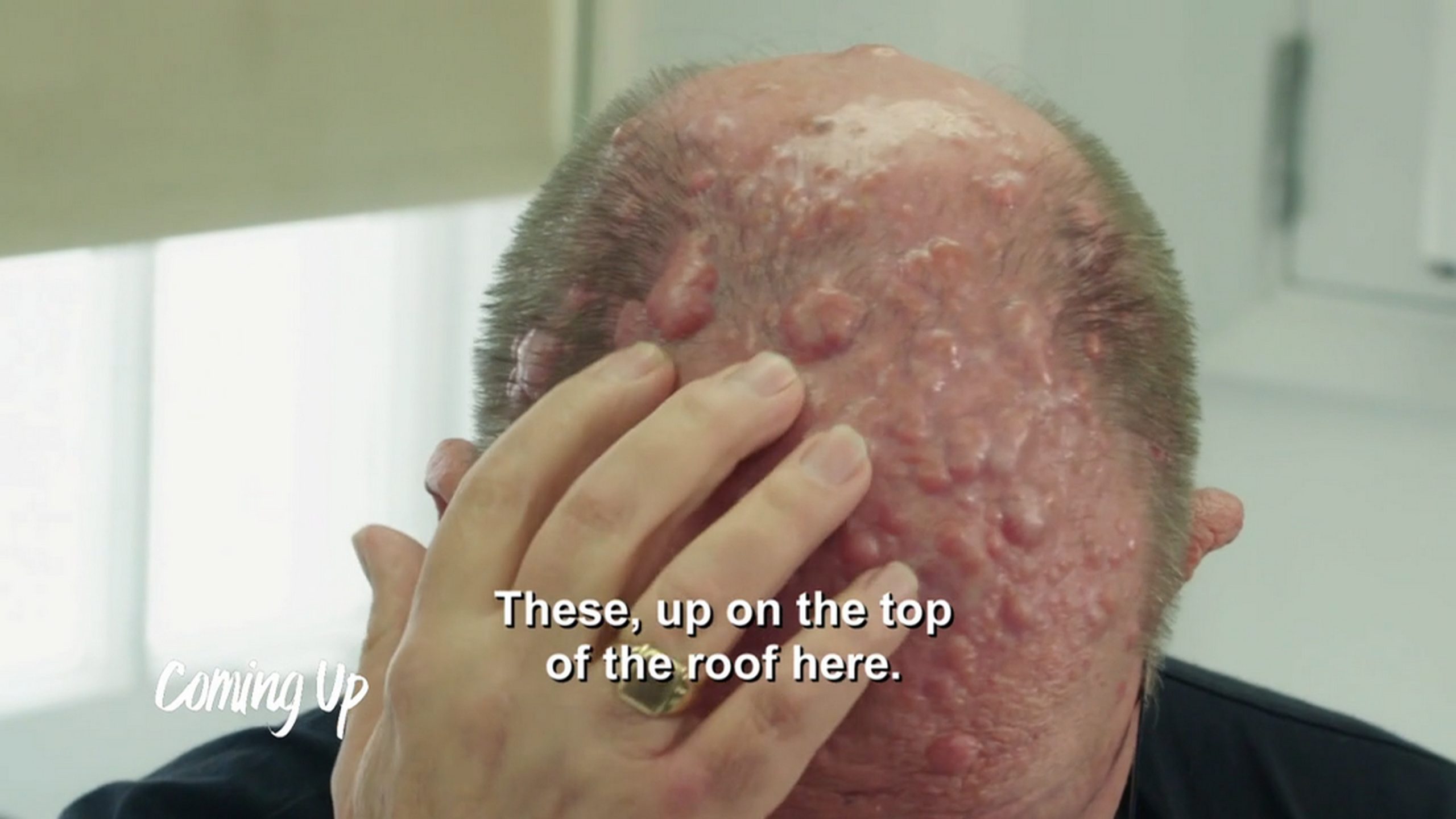 Dr. Emma performs the newly named Victor Technique on a man plagued by bumps. SaveMySkin 230626