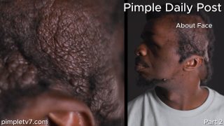 Dr. Panossian and Dr. Rovelo join forces to remove a massive tumor that has wrapped around a man’s head. About Face 160626