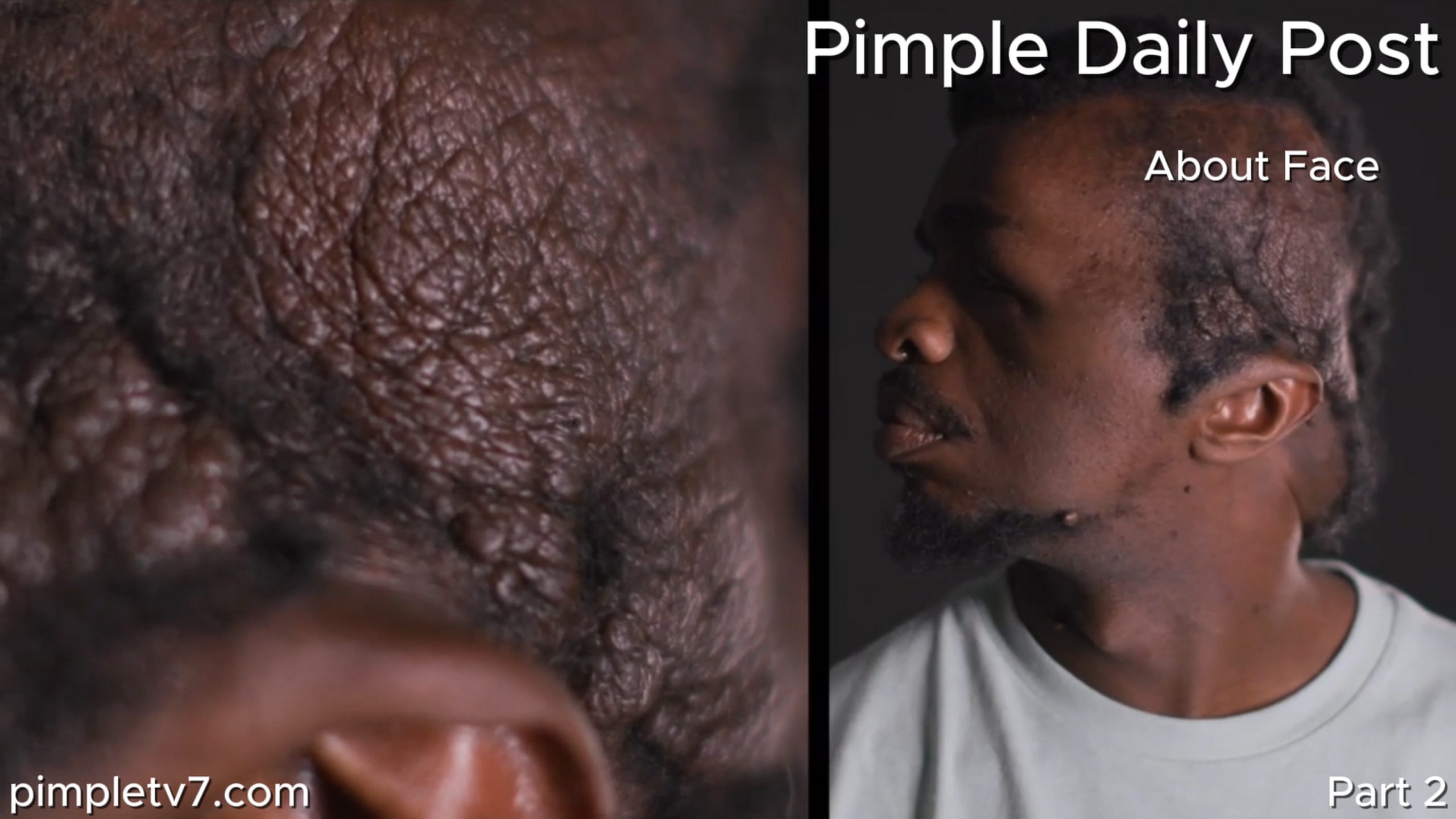 Dr. Panossian and Dr. Rovelo join forces to remove a massive tumor that has wrapped around a man’s head. About Face 160626