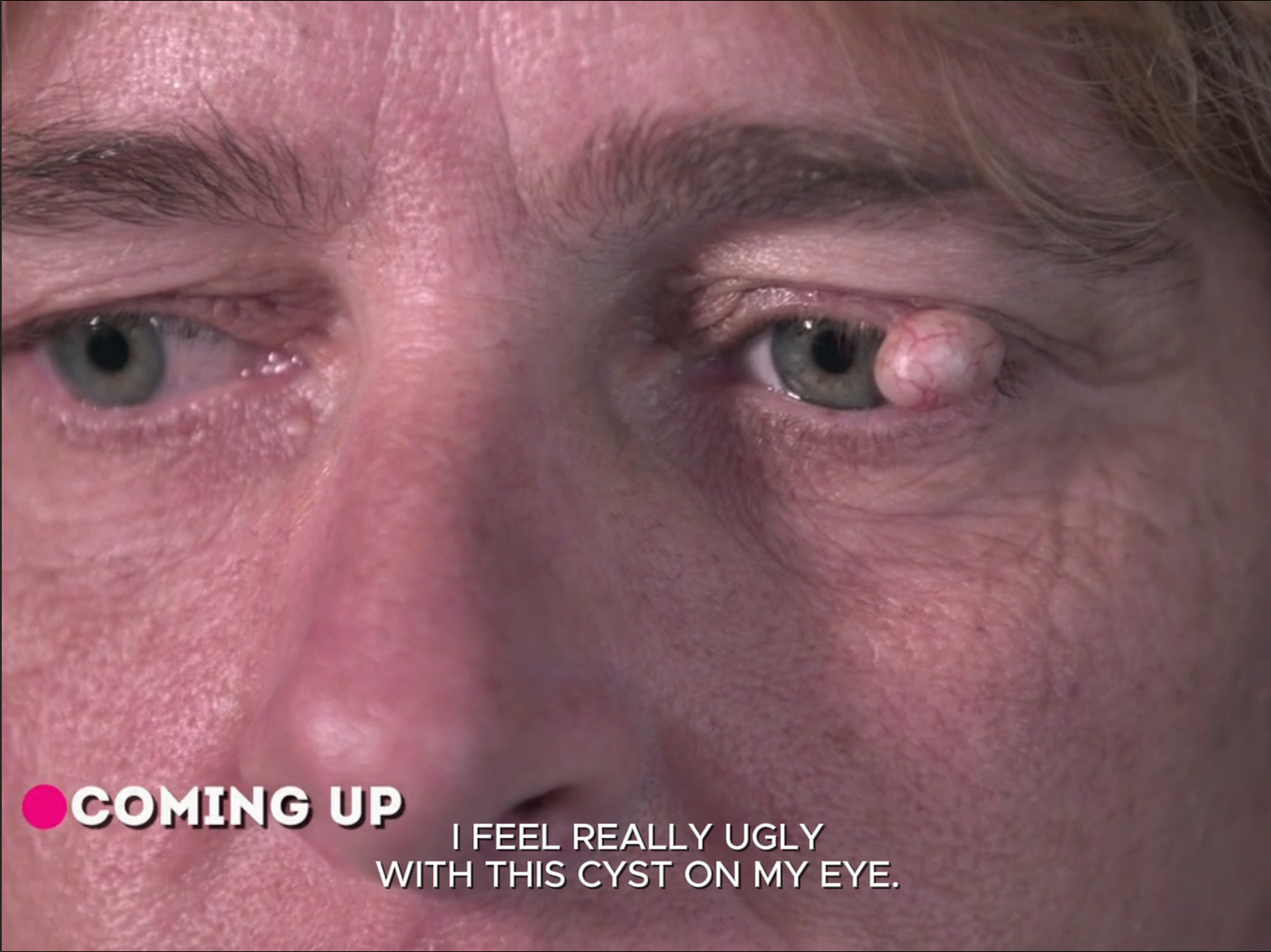 Kristy’s eyelid cyst is ruining her life. It Started Swelling. Dr. Pimple Popper 150626
