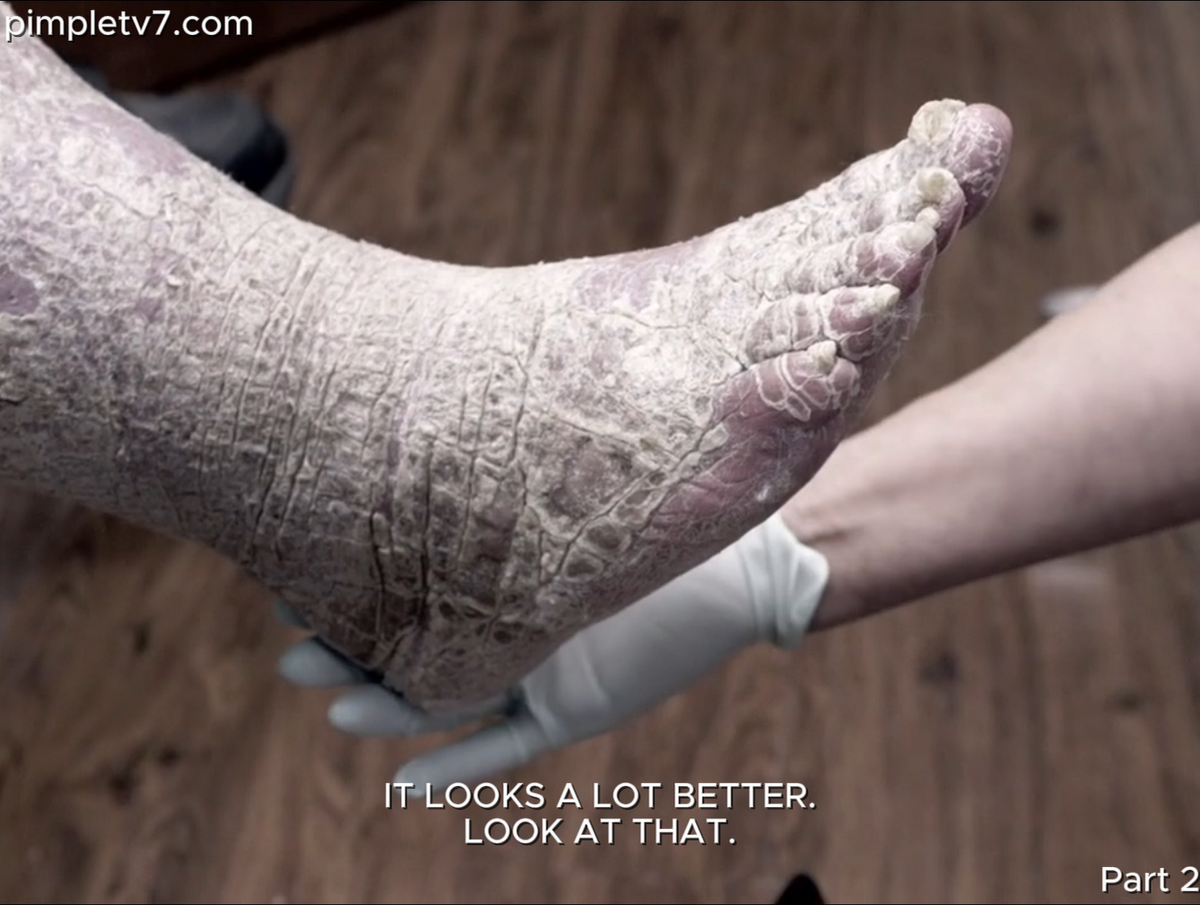 Dr. Sandra Lee assists Louis, who is covered in scaly, dry skin that makes him feel like an alligator. Dr. Pimple Popper 180626