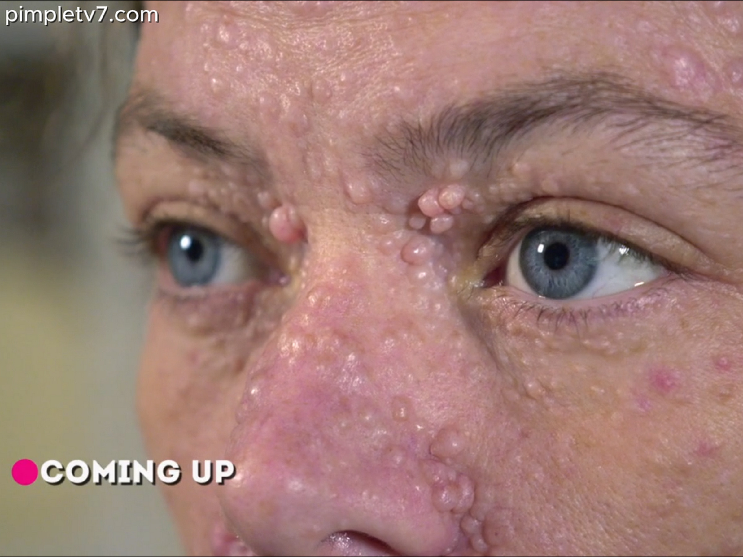 Dr. Sandra Lee helps Amber, who has hundreds of tumors on her face. Dr. Pimple Popper 200626