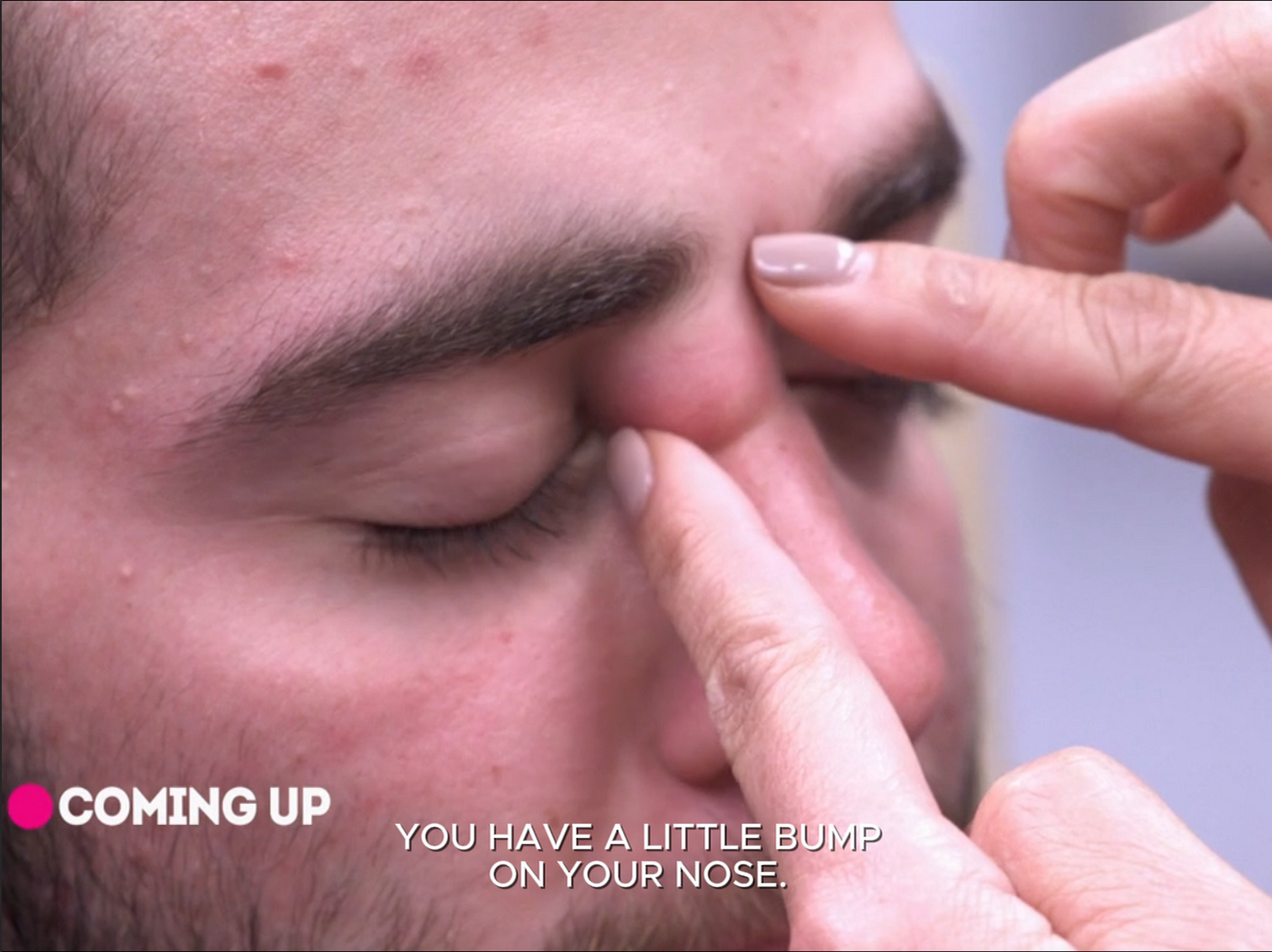 Dr. Sandra Lee helps Anthony, who has a facial cyst in an area called the triangle of death. Dr. Pimple Popper 160626