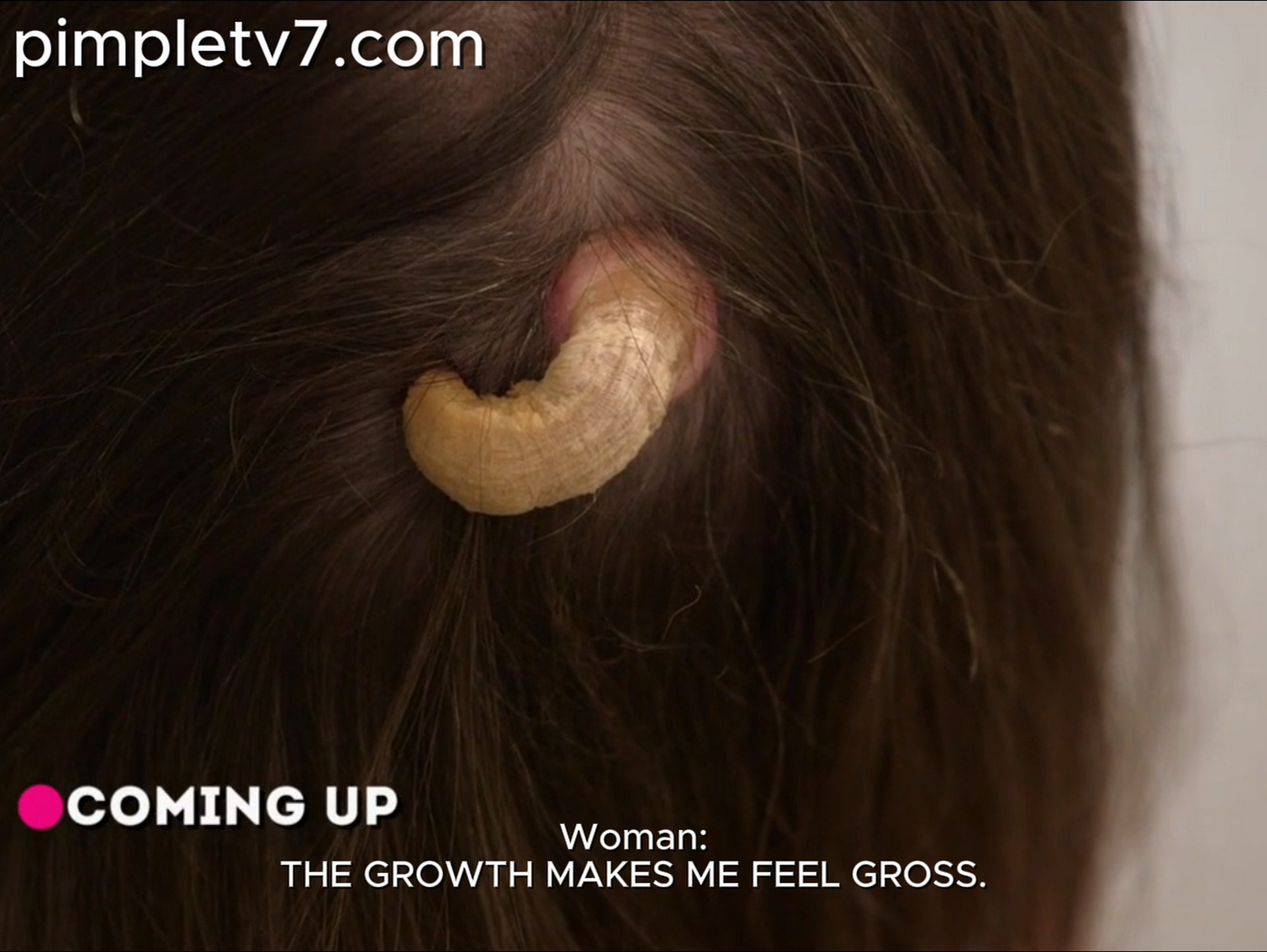 Dr. Sandra Lee helps Lisa who has a horn growing out of the back of her head and fears that it could be cancer. Dr. Pimple Popper 230626
