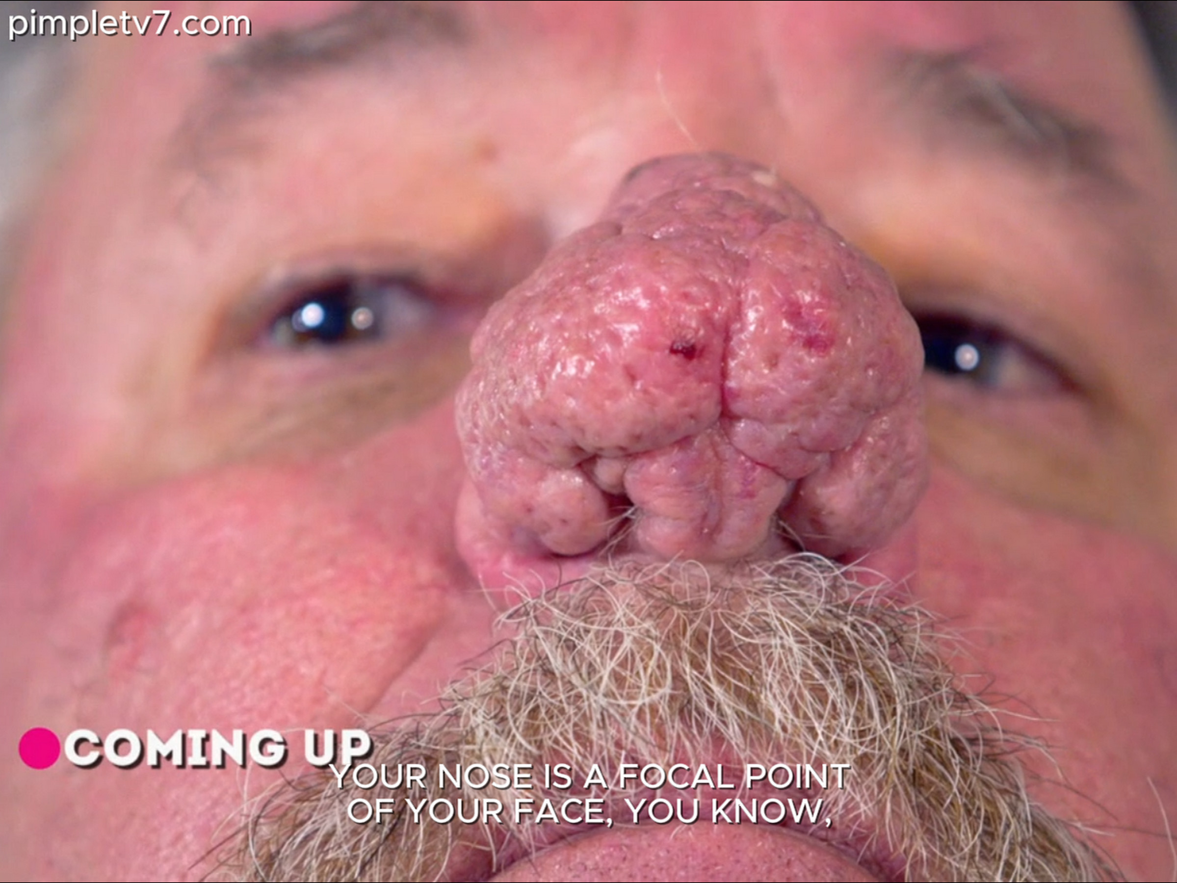 Dr. Sandra Lee helps Patrick with huge bumps covering his nose. Dr. Pimple Popper 220626