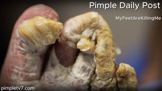 Dr. Sarah treats a bad case of fungus and disfigured toenails. MyFeetAreKillingMe 190626