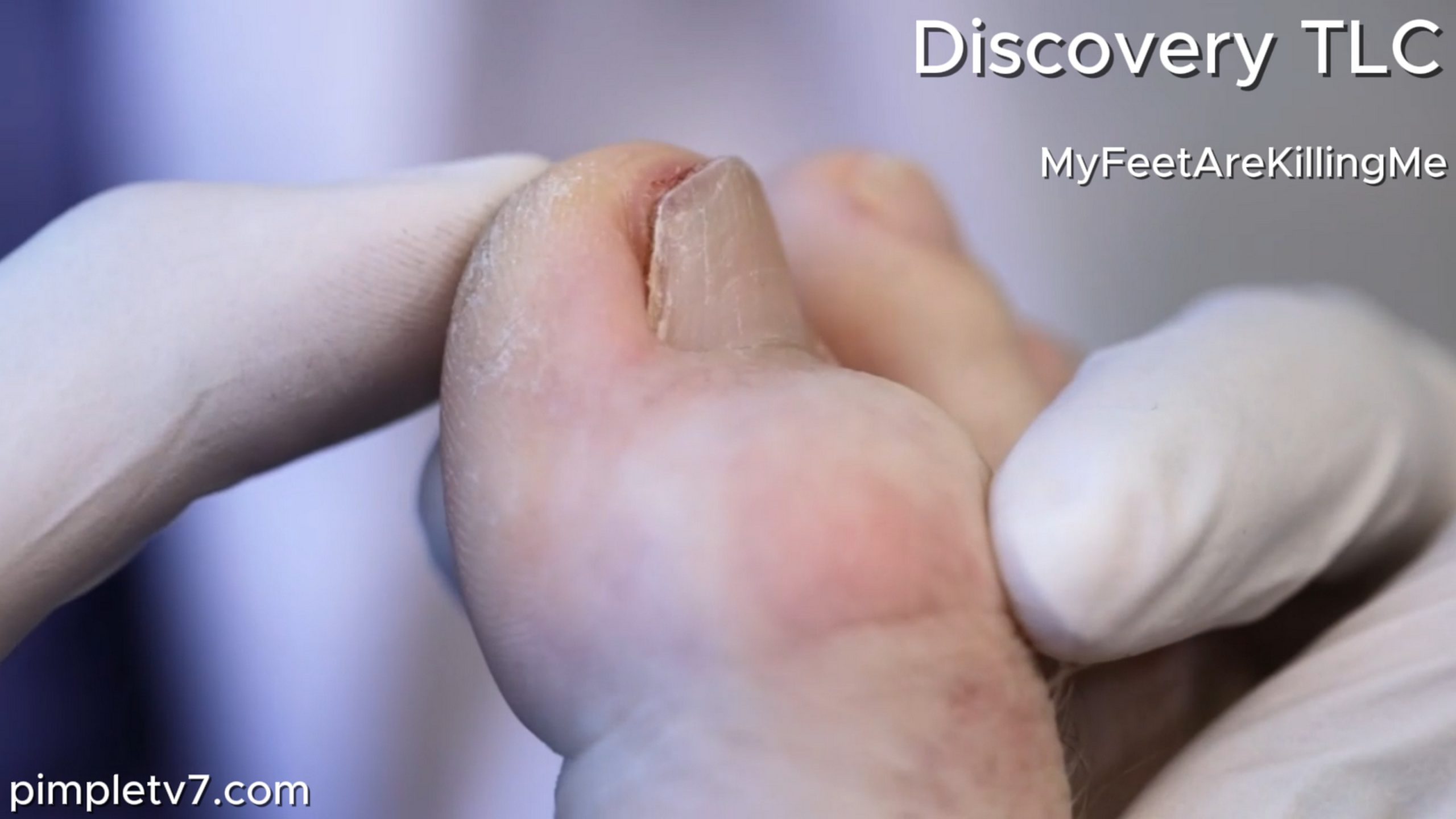 Dr. Vincent gets a drummer’s foot back on the beat. MyFeetAreKillingMe 170626