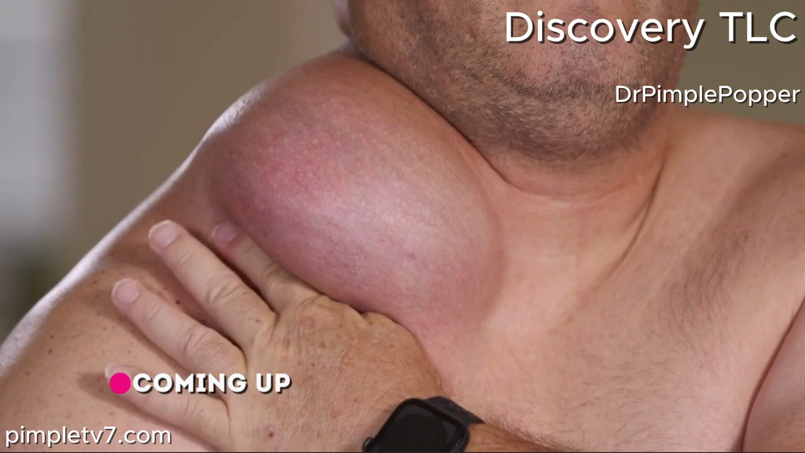 Gabriel has a huge growth on his clavicle but is terrified of surgery. Dr. Pimple Popper 190626
