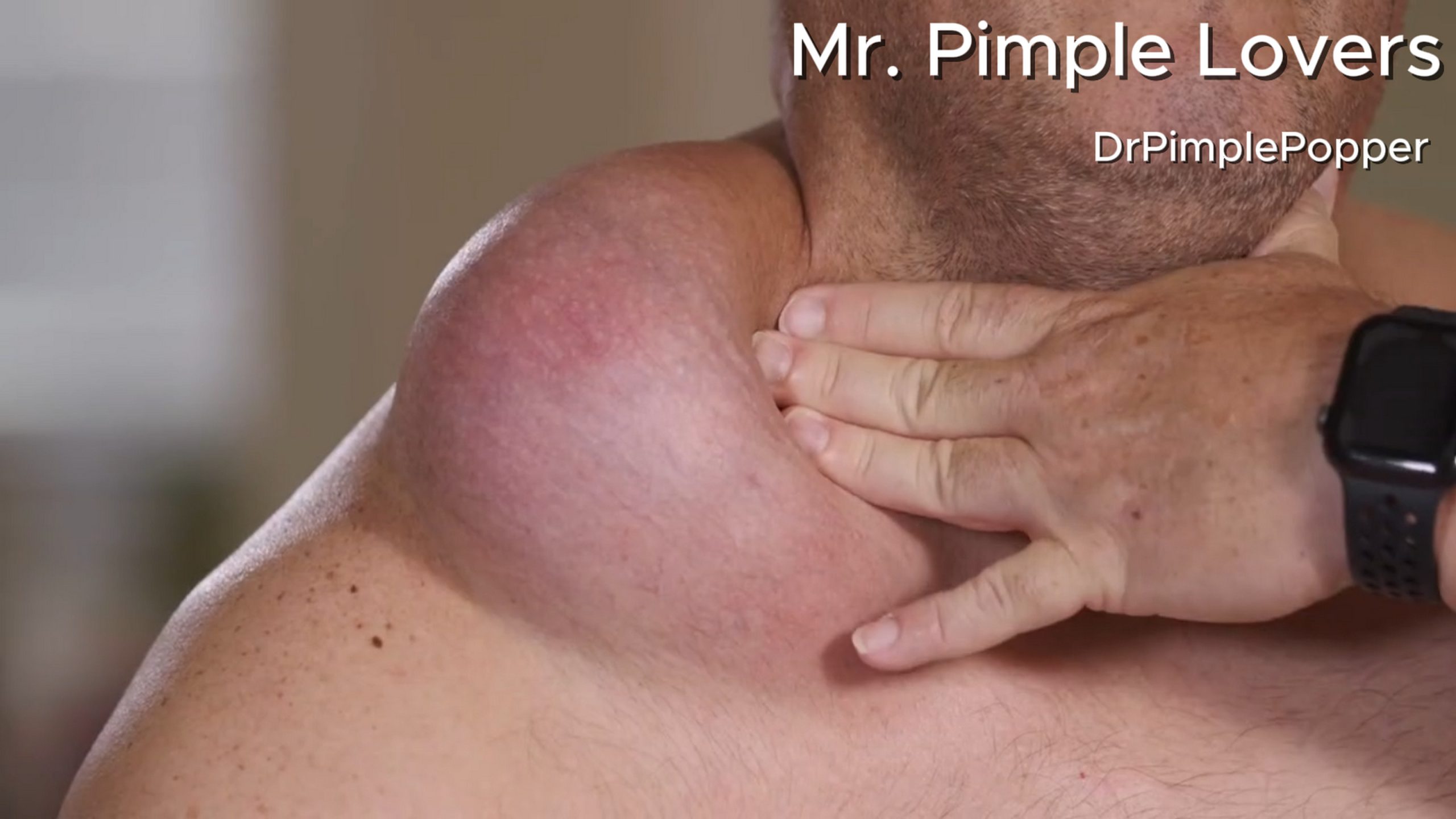 Gabriel has a huge growth on his clavicle but is terrified of surgery. Dr. Pimple Popper 140626