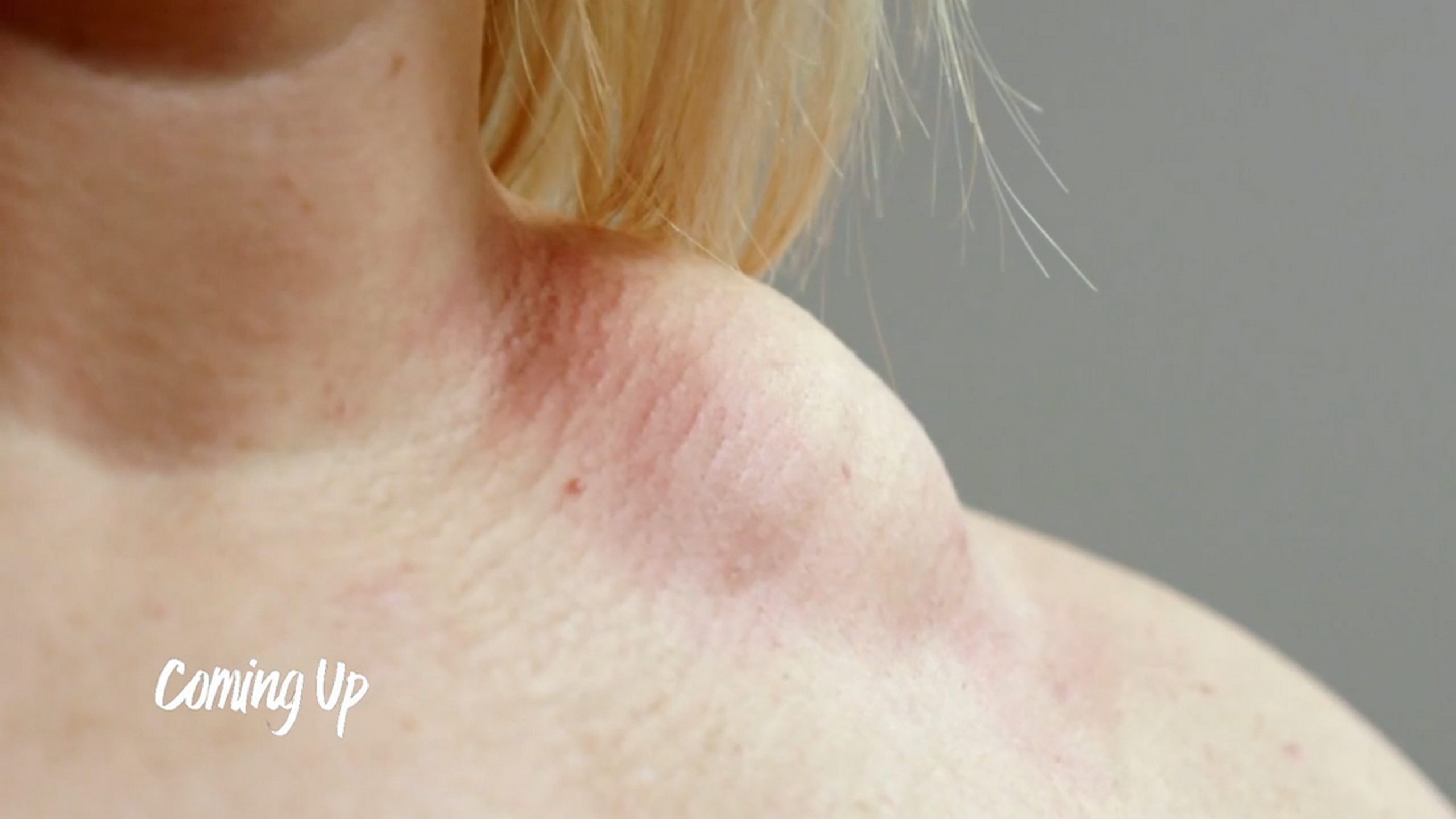 Gemma’s dream of having a baby is hampered by the lump on her shoulder. SaveMySkin 270626