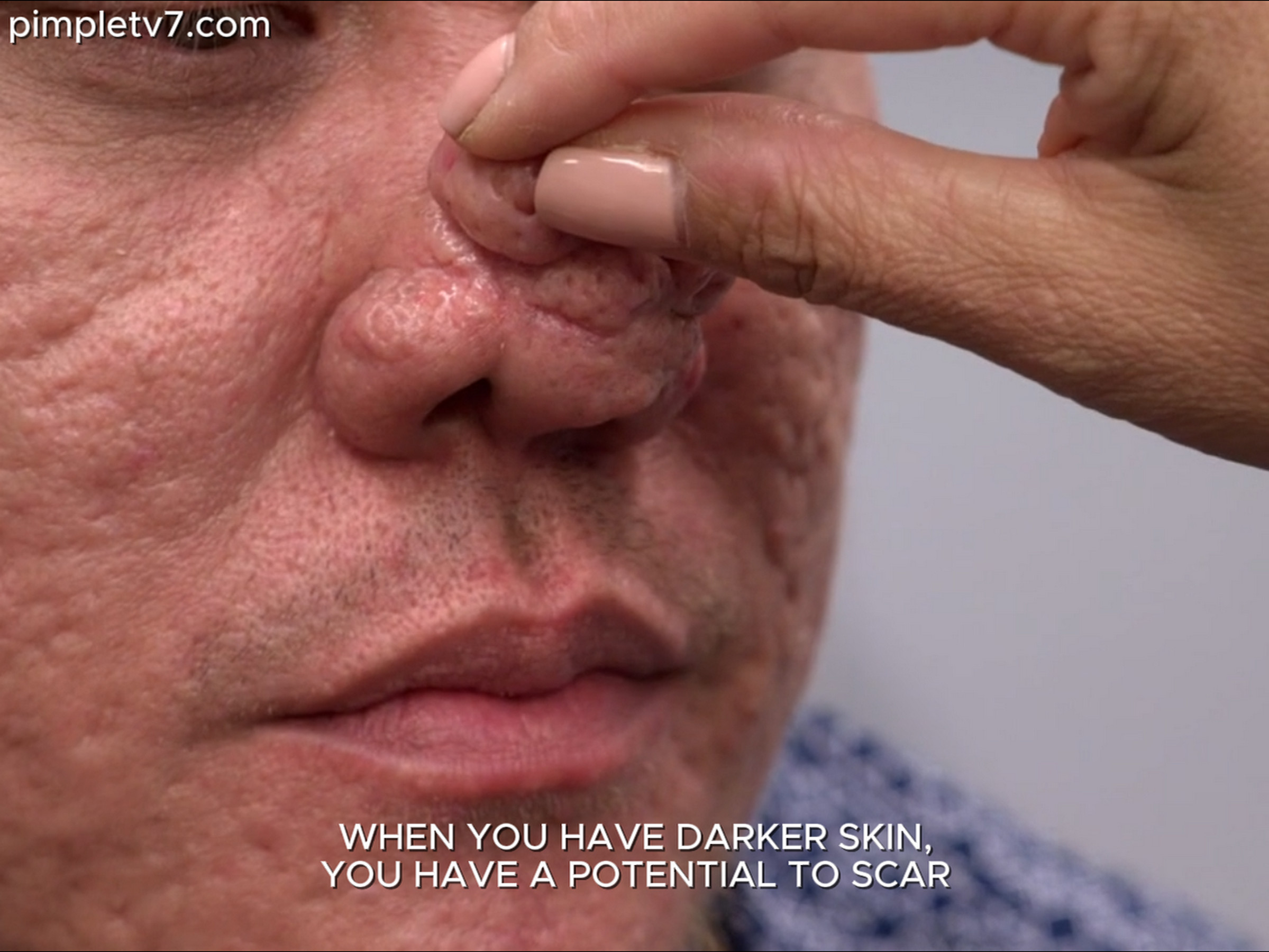 Genner has flown all the way from the Philippines to have Dr. Lee help with his bumpy nose. Dr. Pimple Popper 150626