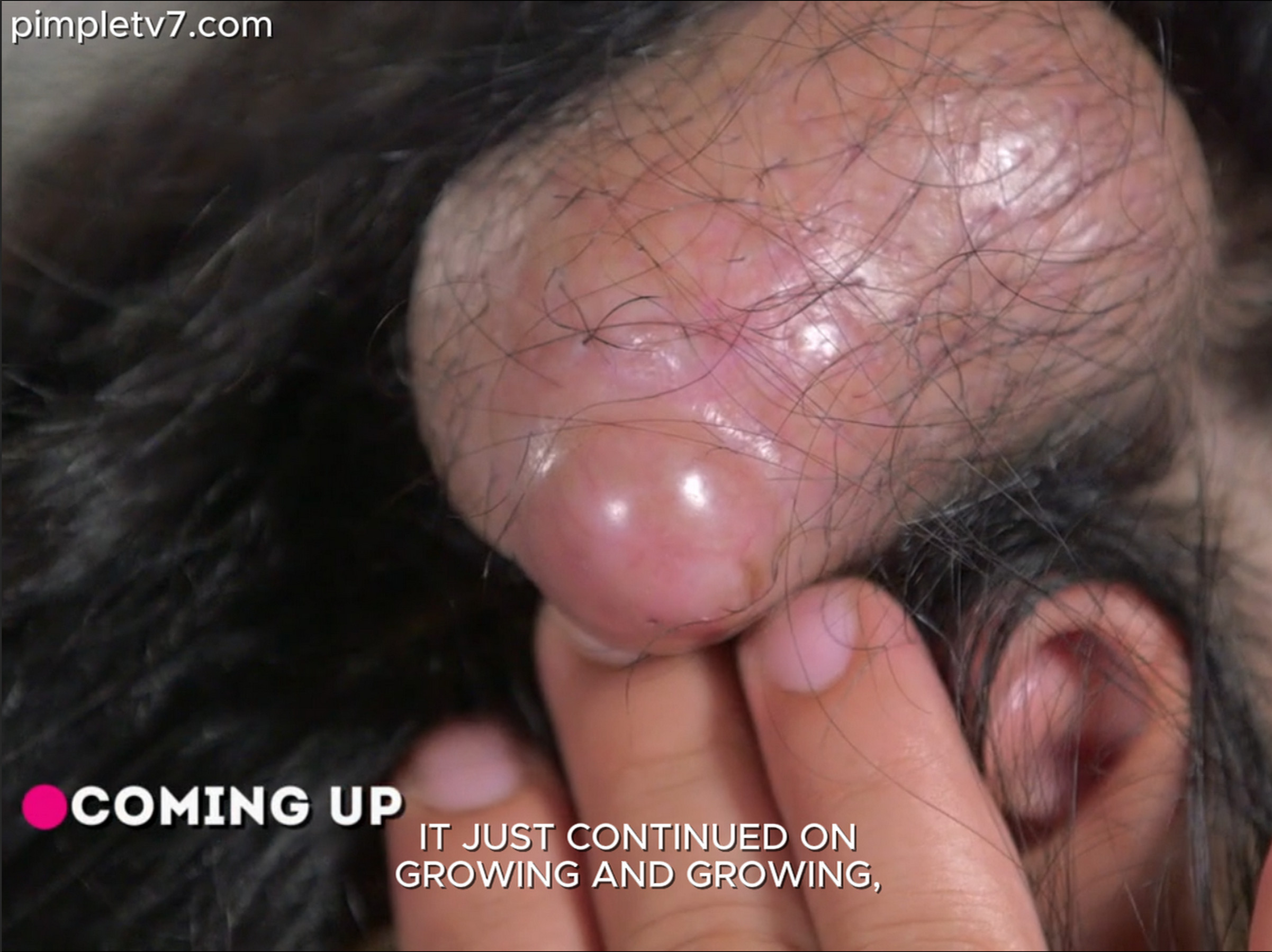 Dr. Sandra Lee: Irais’s kids are bullied because of the growth on her head. Dr. Pimple Popper 190626