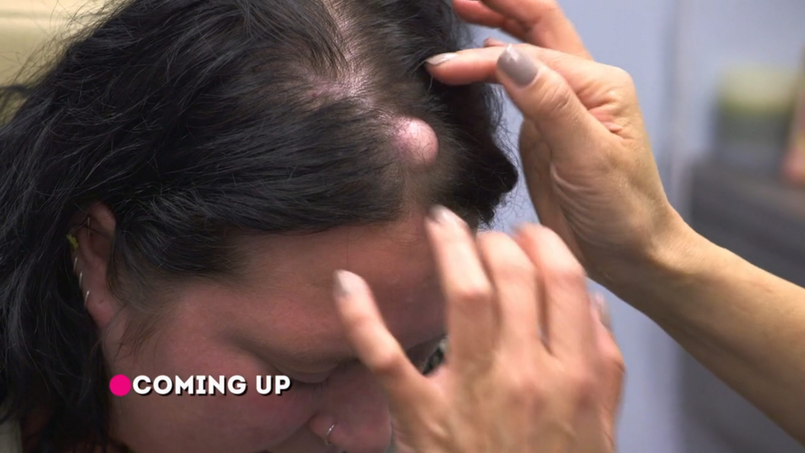 Jennifer has a unicorn bump on her forehead. Dr. Pimple Popper 260526