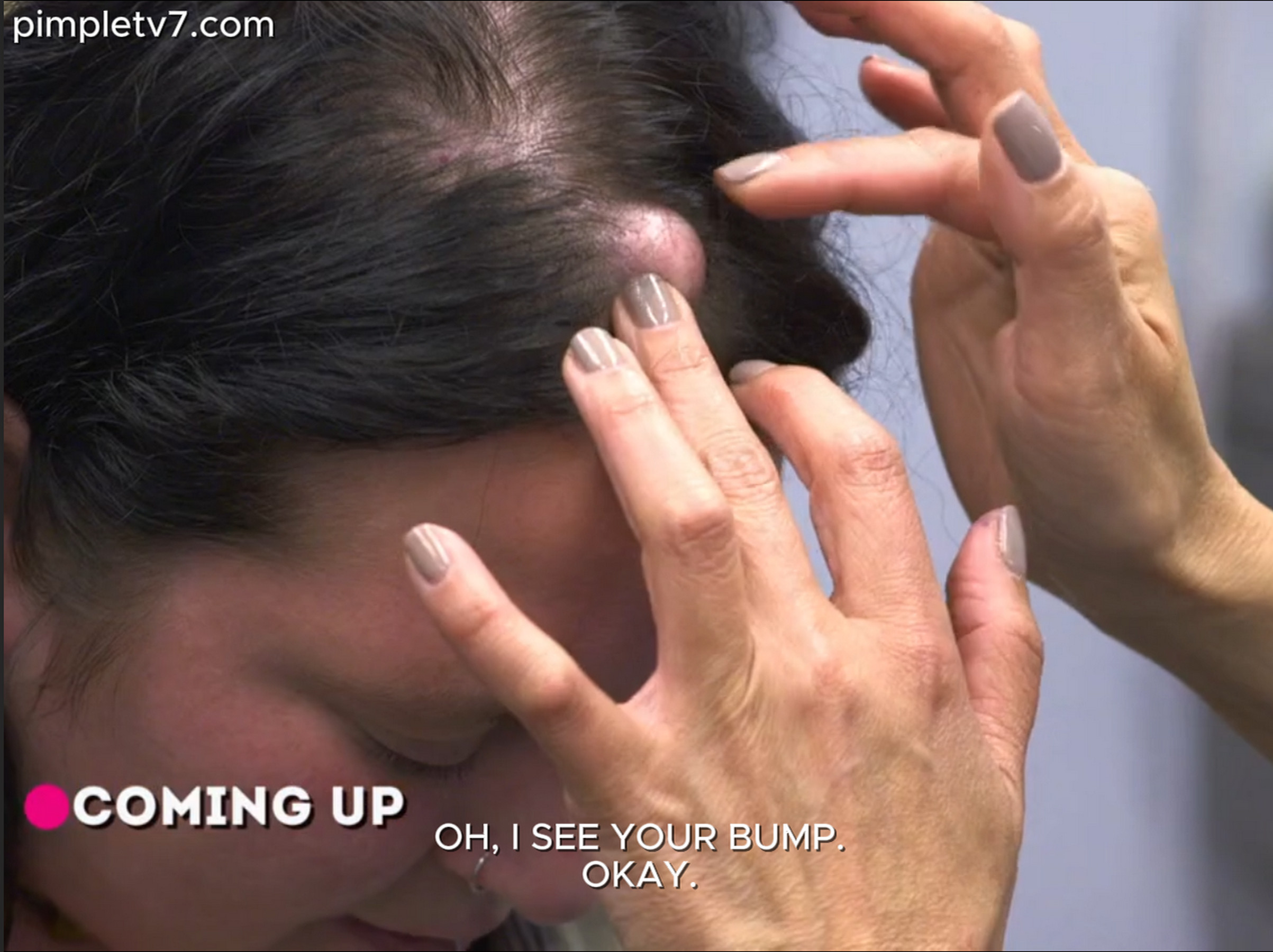Jennifer has a unicorn bump on her forehead. Dr. Pimple Popper 170626