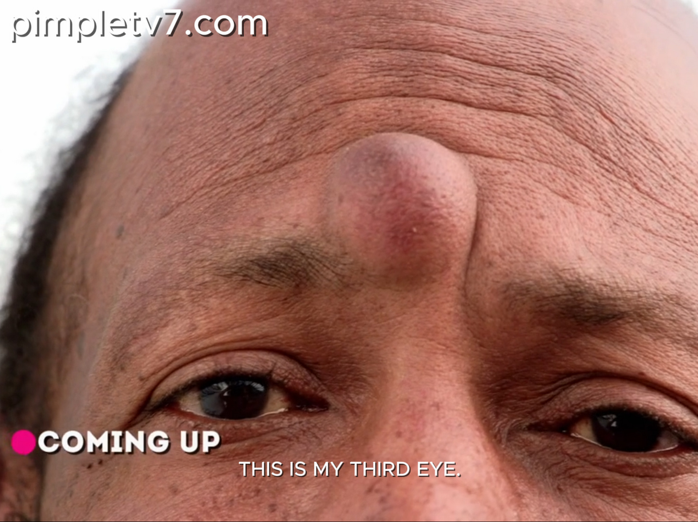 Joe has a mound in the middle of his forehead that looks like a third eye. Dr. Pimple Popper 230626