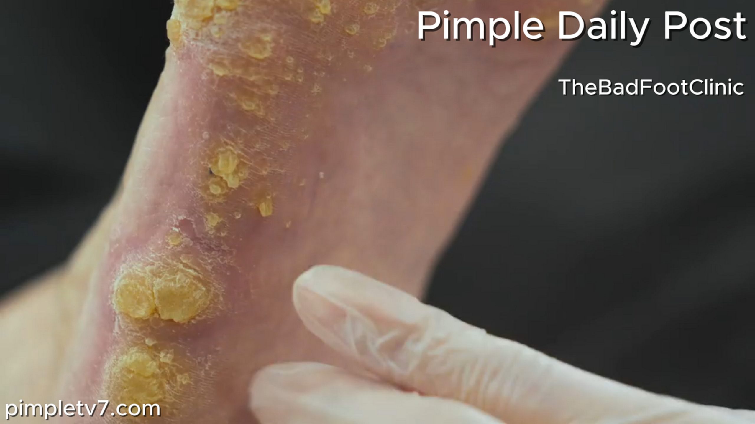 Julie, they’re awful, calloused lumps and bumps mainly at the sides of the foot. TheBadFootClinic 180626