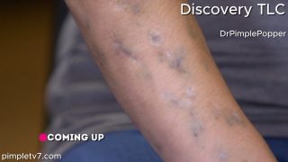 Kaitlin has blue marks and scars up and down her arms due to long-term drug use. Dr. Pimple Popper 220626