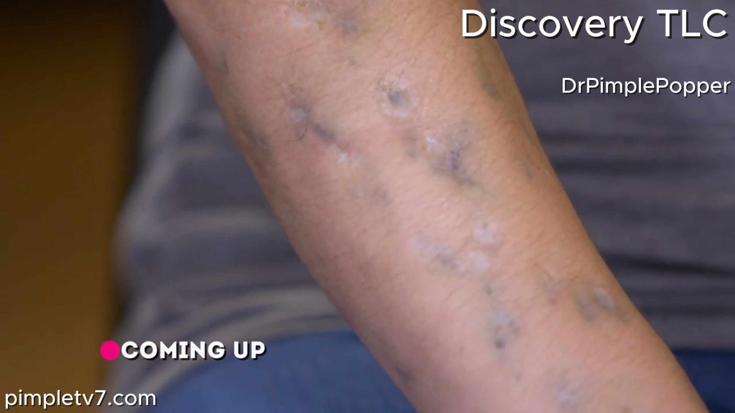Kaitlin has blue marks and scars up and down her arms due to long-term drug use. Dr. Pimple Popper 220626