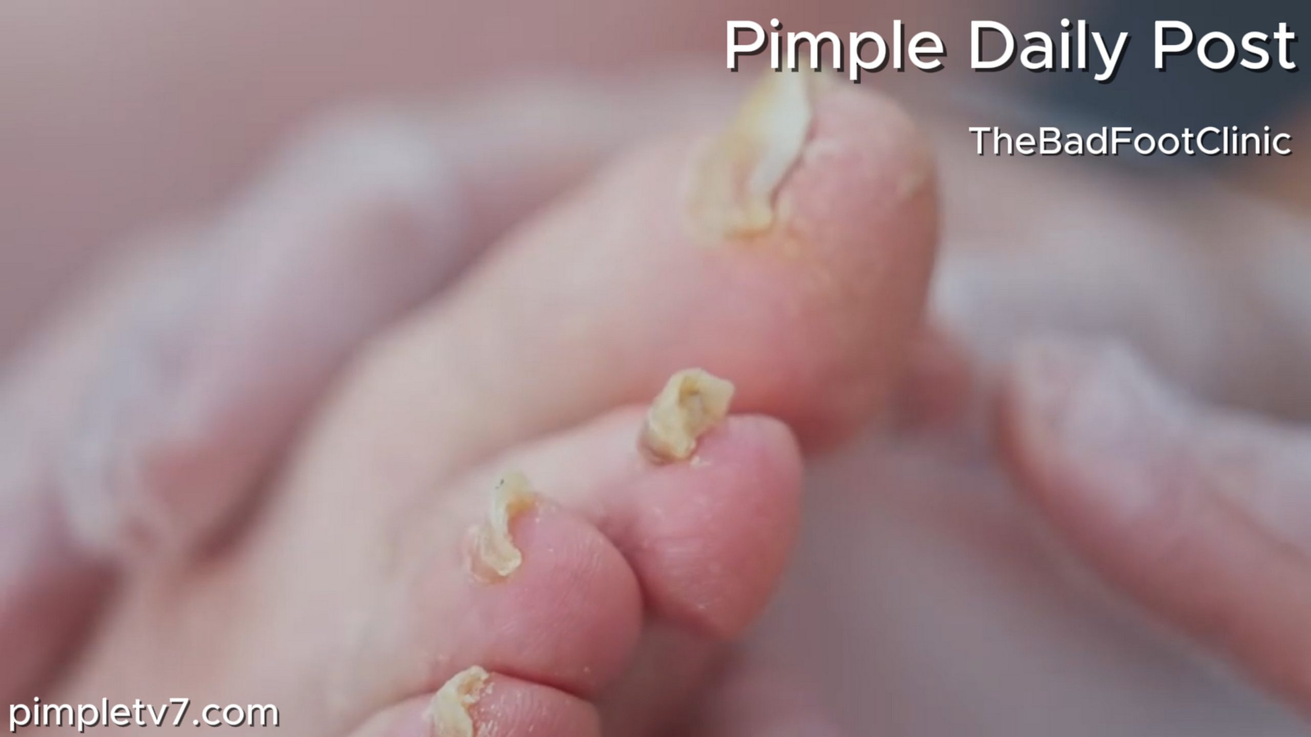 Lan’s toenails are in a terrible state. They’re curved, thick, and hard to cut. TheBadFootClinic 180626