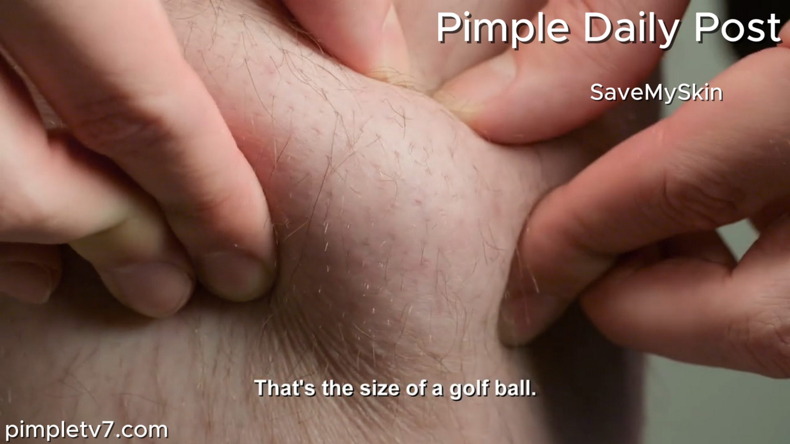 Levi worries that the bigger his muscles get, the more visible the lumps on his body will become. SaveMySkin 200626