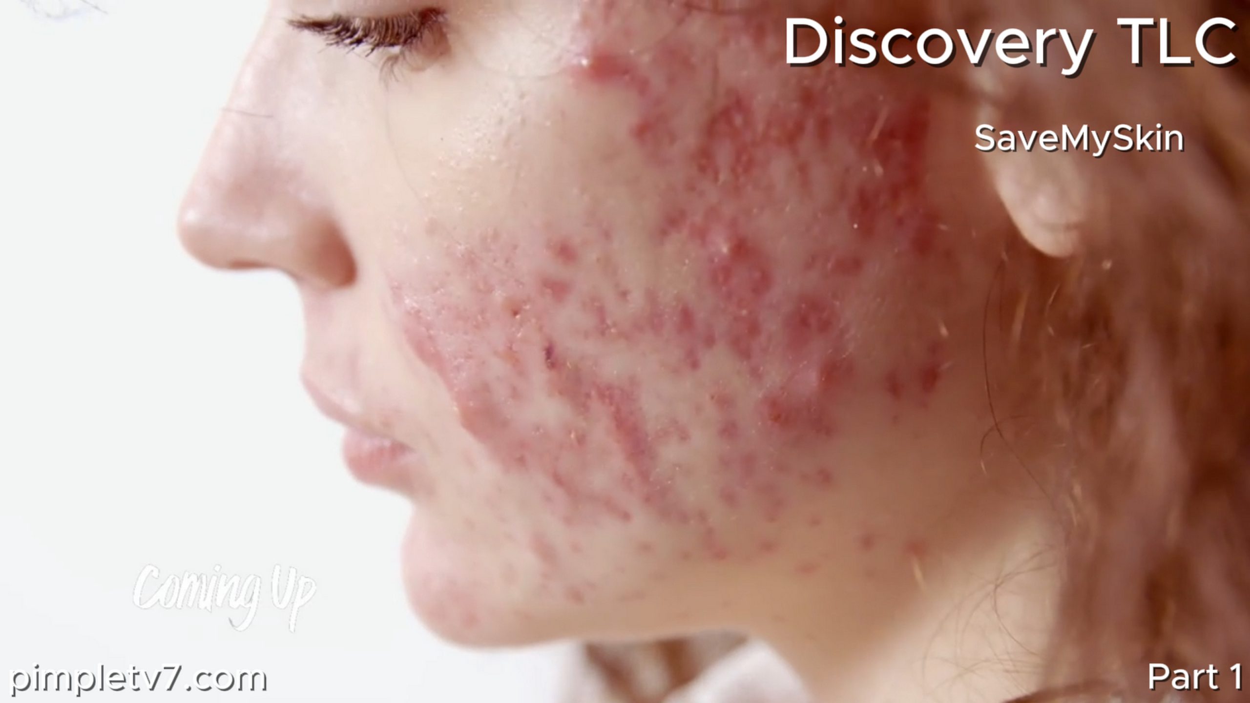 Mariah’s acne has completely destroyed her self-confidence. SaveMySkin 180626
