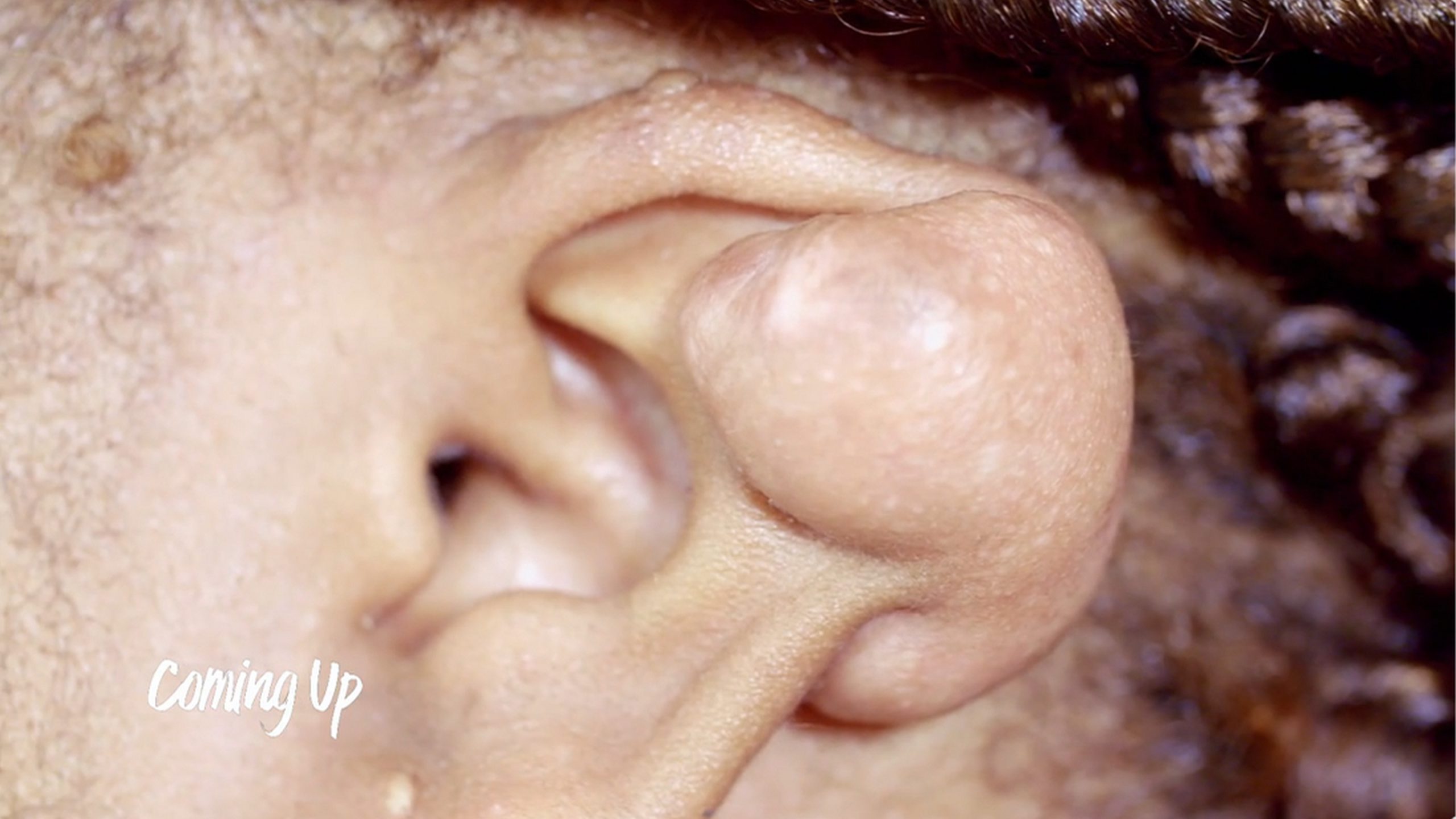 Onique can feel the people staring at the lump on her ear. SaveMySkin 230626
