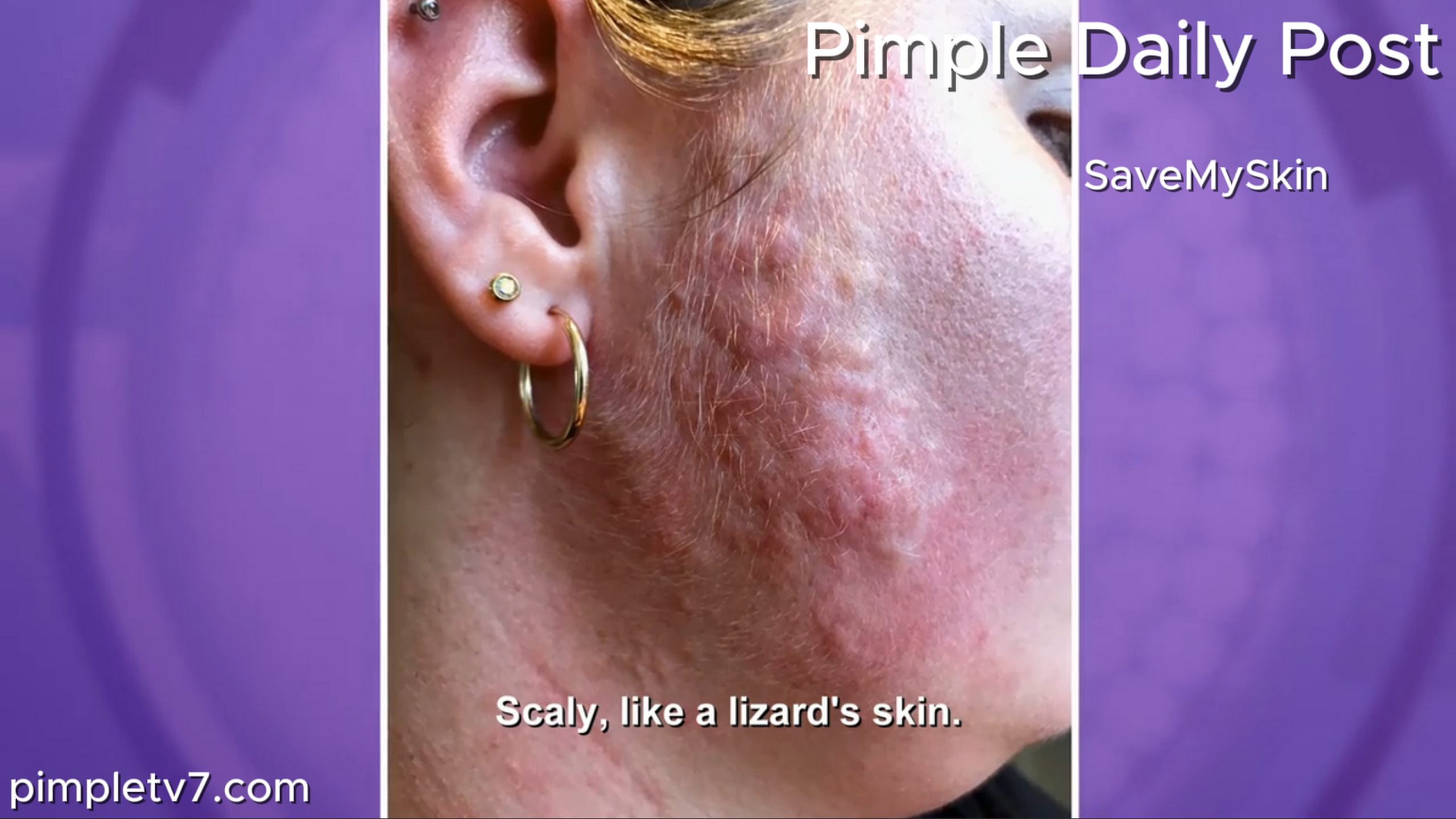 Painful, itchy lumps have been spreading across Laura’s face. SaveMySkin 210626