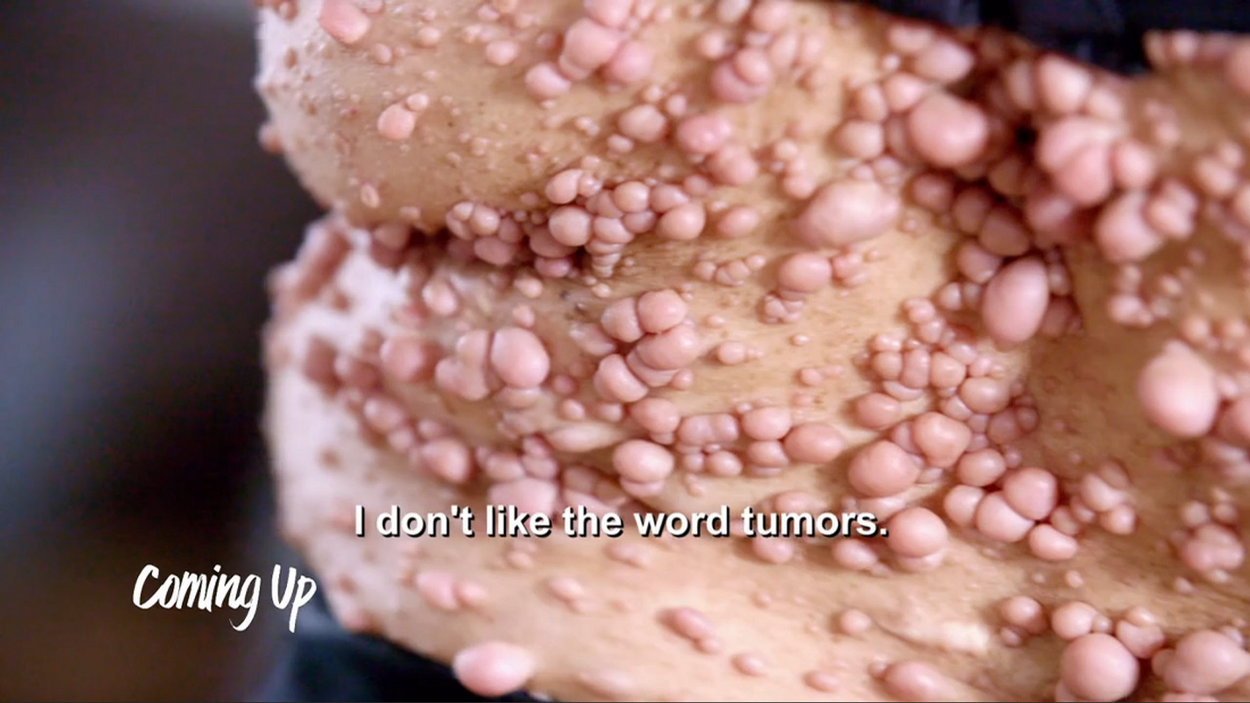 Rachael’s body is covered in hundreds of squishy bumps. SaveMySkin 240626