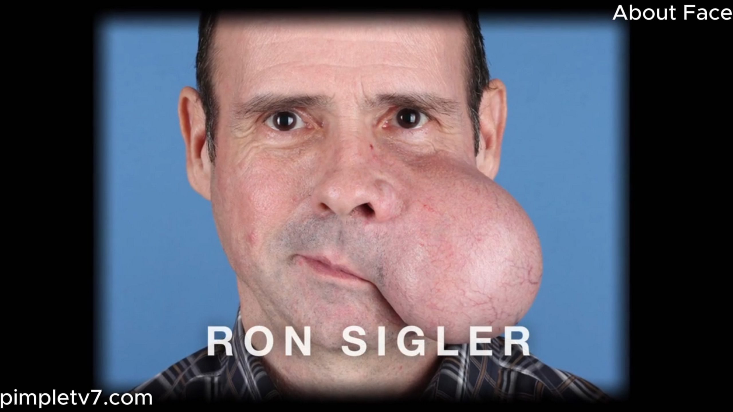 Ron Sigler, when faced with treating a man whose cheek is about to pop due to a 4lb tumor, Dr. Panossian worries it could become a deadly situation. About Face 250626