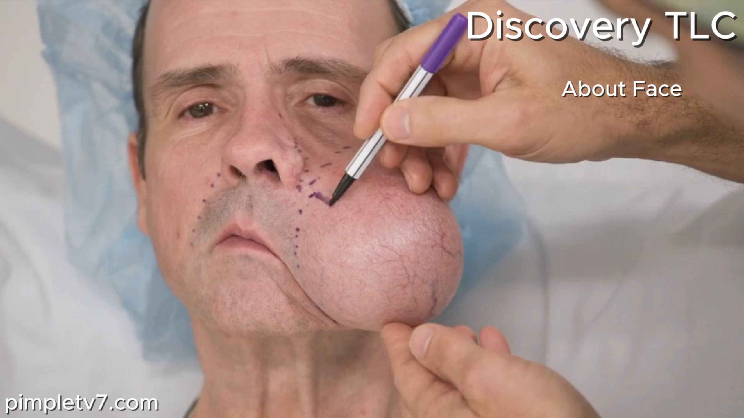 Ron Sigler, when faced with treating a man whose cheek is about to pop due to a 4 lb tumor, Dr. Panossian worries it could become a deadly situation. About Face 140626