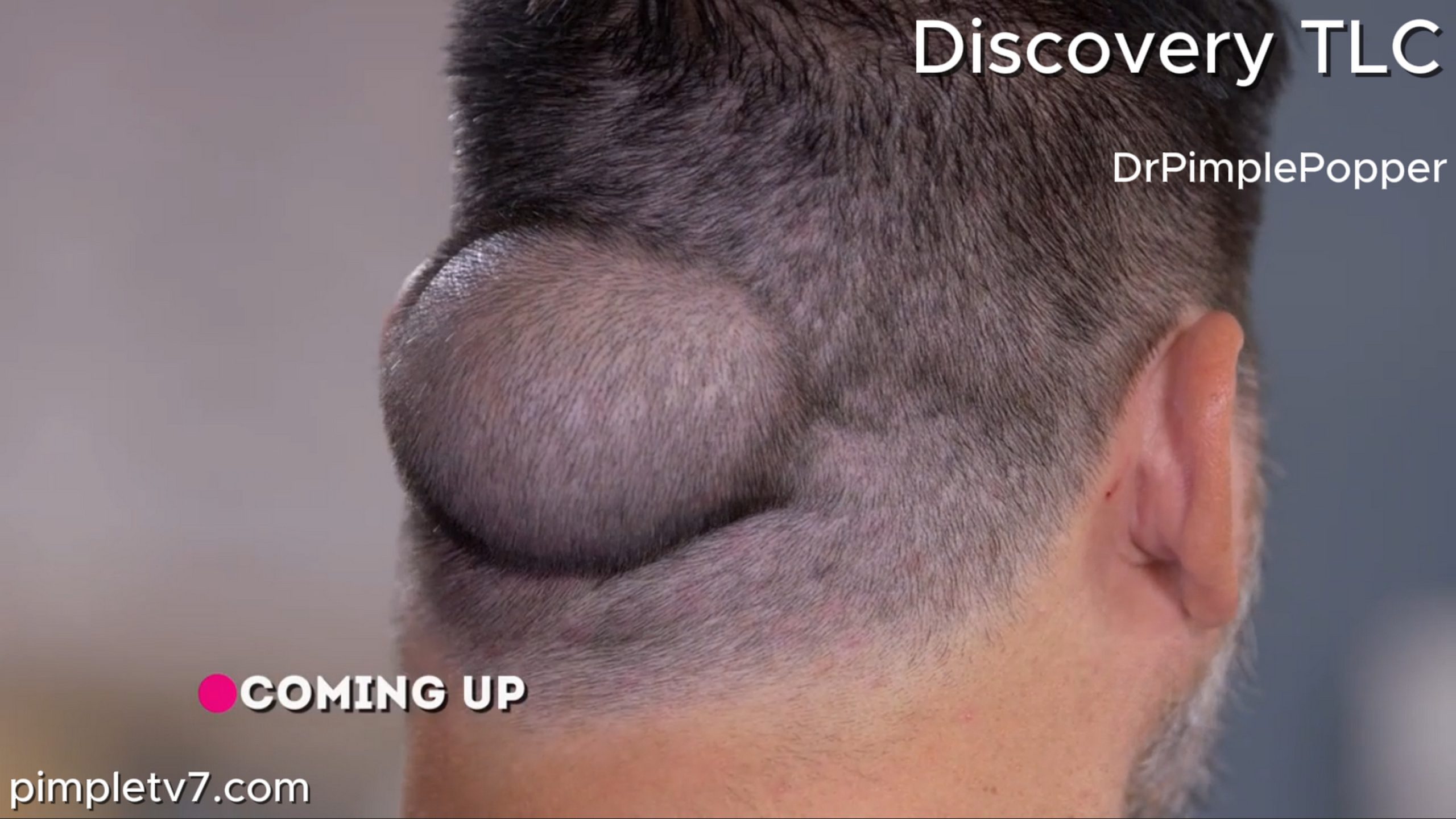 Ruben is a personal trainer whose head growth has prevented him from seeing clients. Dr. Pimple Popper 210626